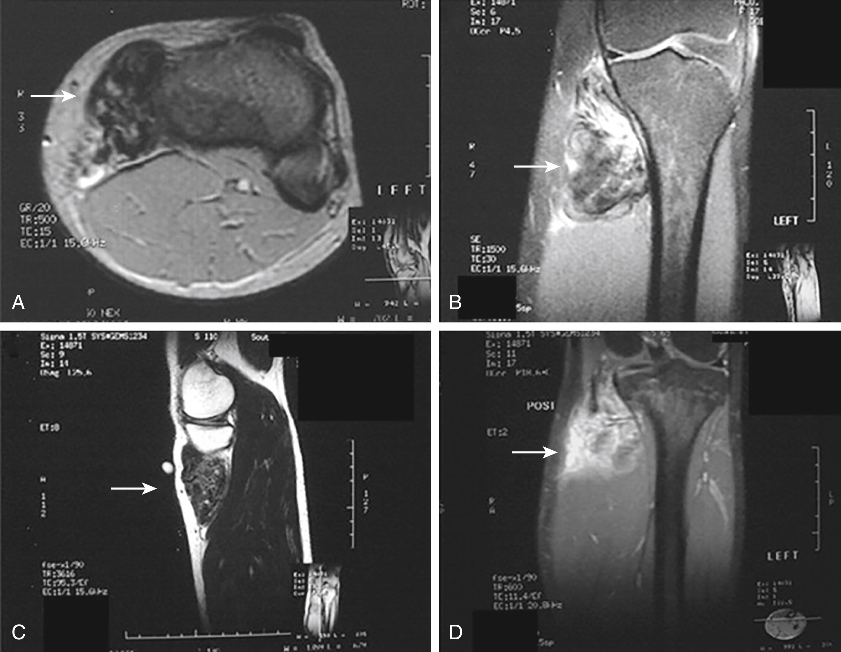 FIG. 161.5, Magnetic resonance imaging with (A) axial fat-saturated T1, (B) coronal short T1 inversion recovery, and (C) sagittal T2-weighted images showing a heterogeneous soft-tissue mass at the insertion of pes anserinus conjoint tendon (the markedly decreased interspersed signal on all images is due to hemosiderin deposits). There is no evidence of bone or joint involvement. There is inhomogeneous peripheral and septal enhancement with contrast (D) on a T1-weighted fat-saturated coronal film.