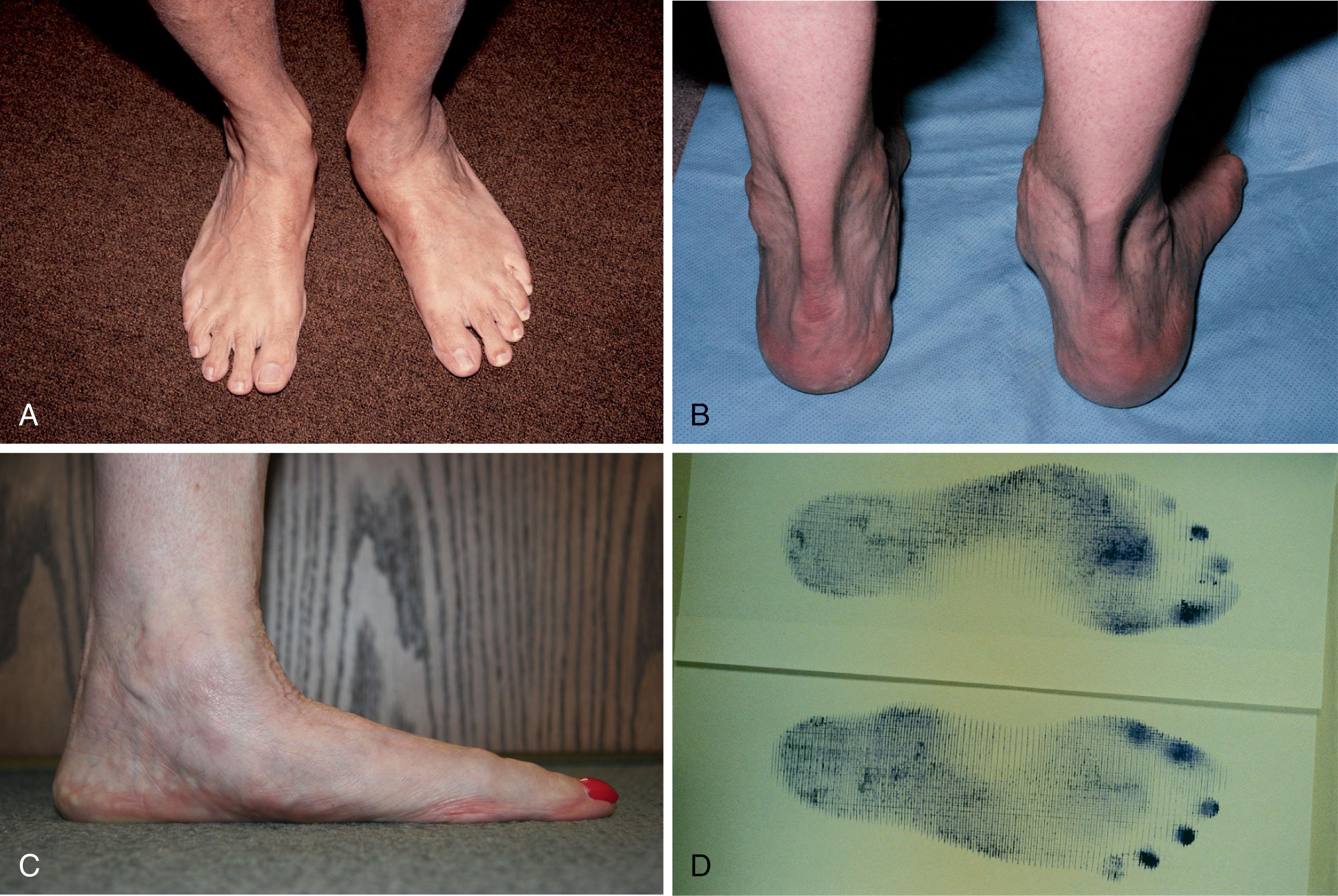 Fig. 29-1, Clinical photographs of deformity after rupture of posterior tibial tendon. A , Dorsal view demonstrating increased abduction and a prominent talar head secondary to subluxation of the talonavicular joint. B , Posterior view demonstrating increased valgus of the calcaneus, increased abduction of the foot, and prominent talar head along the medial border of the foot. C , Medial view demonstrating collapse of the longitudinal arch and the prominence of the talar head. D , Harris mat demonstrating flattening of the longitudinal arch on the right in a patient with posterior tibial tendon dysfunction.