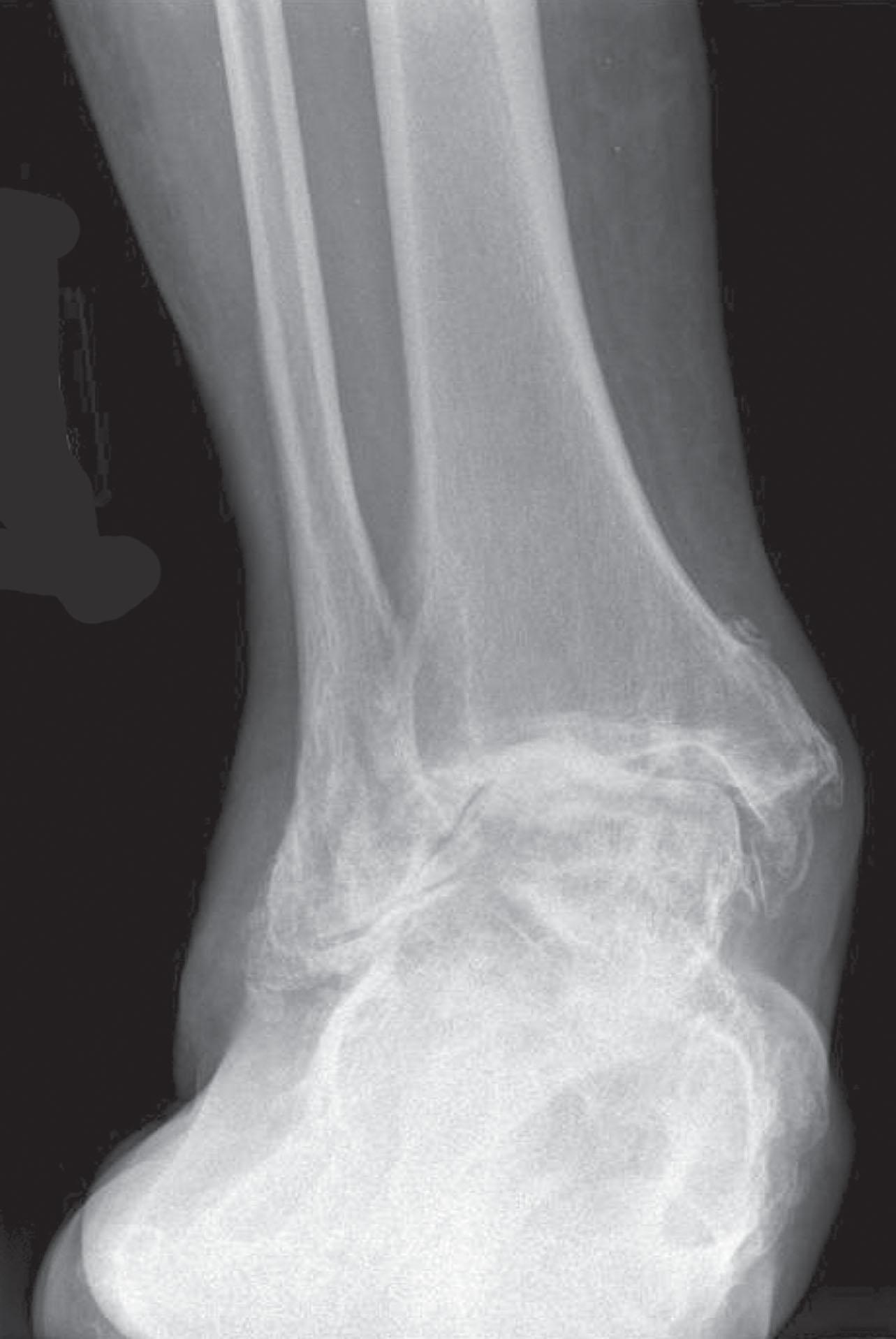 Fig. 29-11, Anteroposterior radiograph of a patient with valgus incongruent ankle arthritis secondary to progressive collapsing foot deformity.