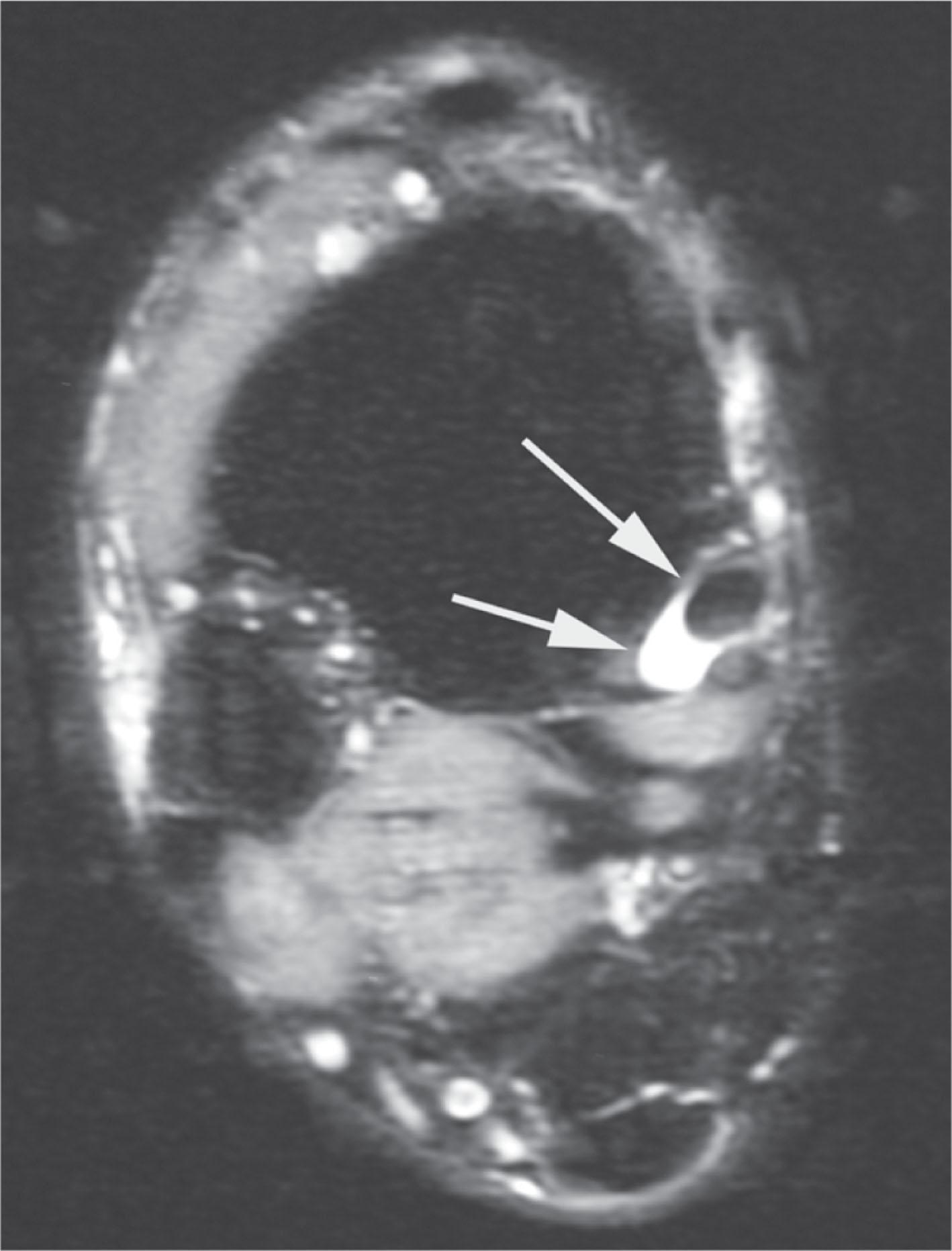 Fig. 29-12, Magnetic resonance imaging demonstrates fluid (arrows) within the sheath of the posterior tibial tendon.