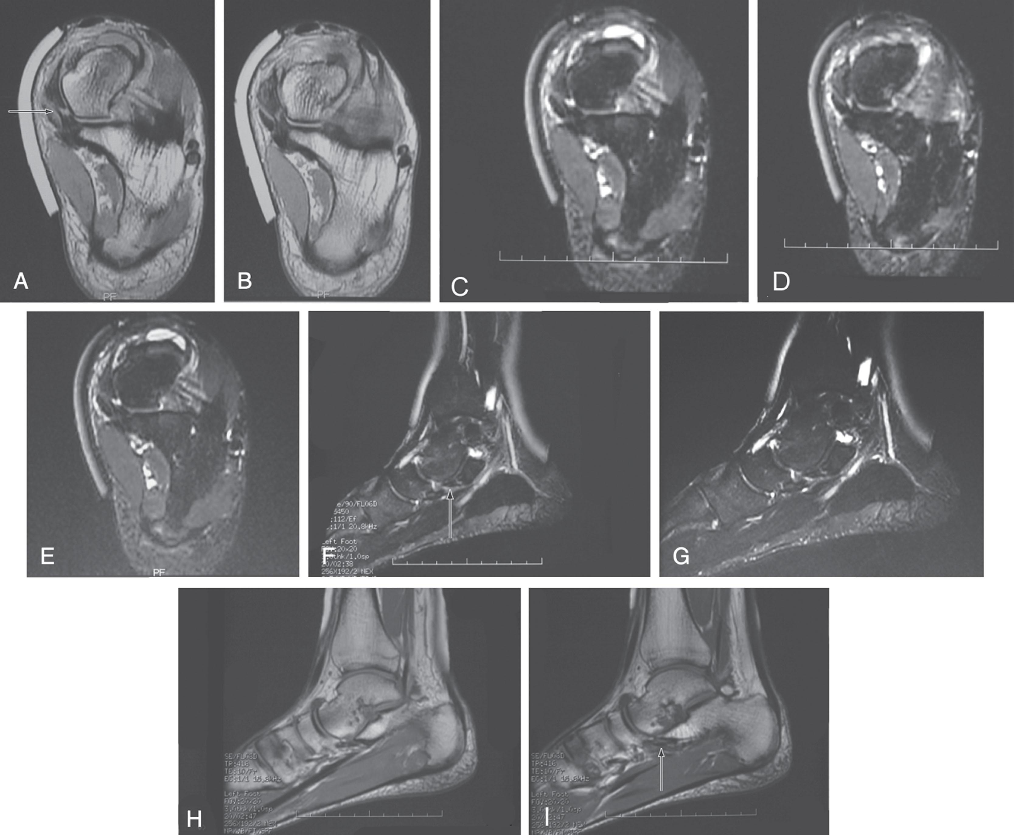 Fig. 29-13, Magnetic resonance imaging (MRI) demonstrates a complete rupture of the superior calcaneal navicular portion of the spring ligament. A and B , T1 images reveal the ruptured ligament (arrow) . C to E , T2 images reveal increased signal at the site of rupture. F and G , The sagittal T2 images emphasize the lack of support of the talar head created by the rupture of the superior calcaneonavicular ligament. H and I , The sagittal T1 images show an attenuated and ruptured ligament.