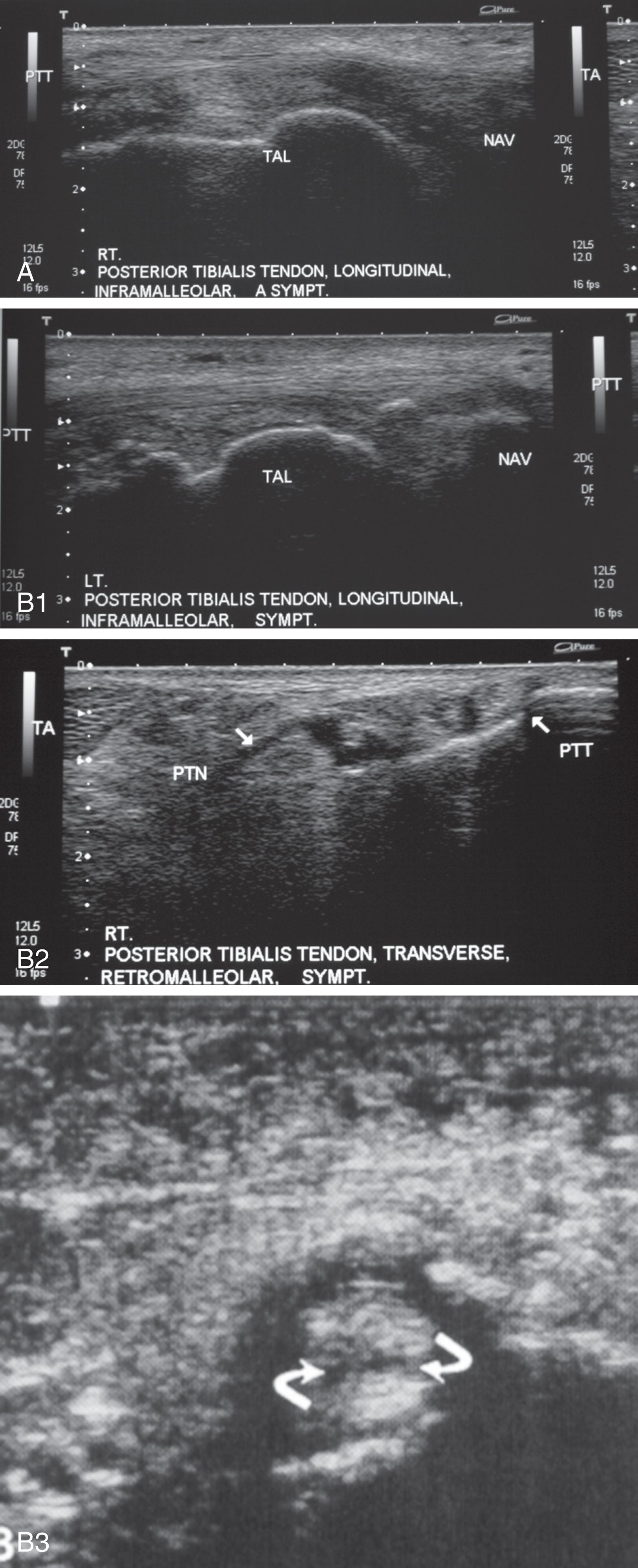 Fig. 29-14, Ultrasound examination of posterior tibial tendon. A , Normal longitudinal orientation of the posterior tibial tendon, medial to the talus (TAL) and navicular (NAV) . B1 to B3 , Pathologic posterior tibial tendon. The pathologic tendon has a longitudinal split tear within it (arrows) .