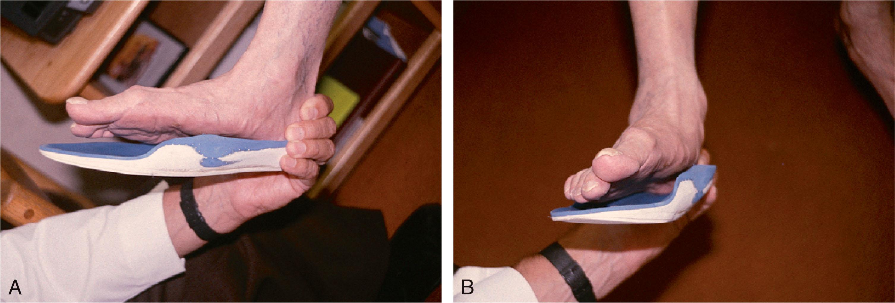 Fig. 29-16, Orthotic device used for posterior tibial tendon dysfunction. A , Medial view demonstrates a fixed varus deformity of the forefoot, which requires medial posting to provide adequate support. B , Frontal view demonstrates the fixed forefoot varus in relation to the orthosis. The medial side of the foot requires adequate support for the orthotic device to be functional.