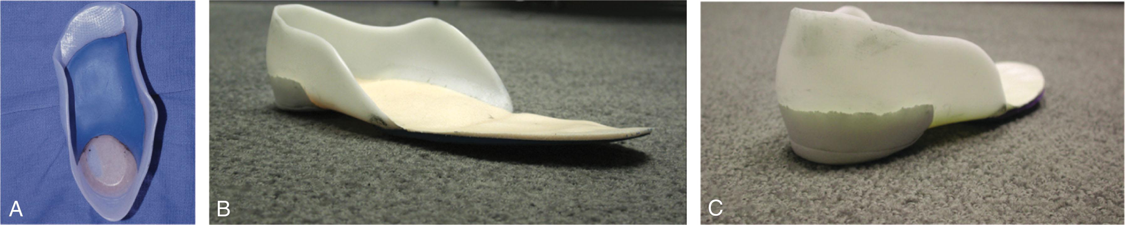 Fig. 29-17, A , University of California Biomechanics Laboratory (UCBL) orthosis. This orthosis functions by stabilizing the heel in neutral and by building up the lateral wall of the device to prevent abduction of the forefoot, thereby helping to reestablish a longitudinal arch in the flexible foot. B , Note higher heel counter allowing better control of heel valgus. C , Note posting of posterior orthosis to assist with hindfoot correction.