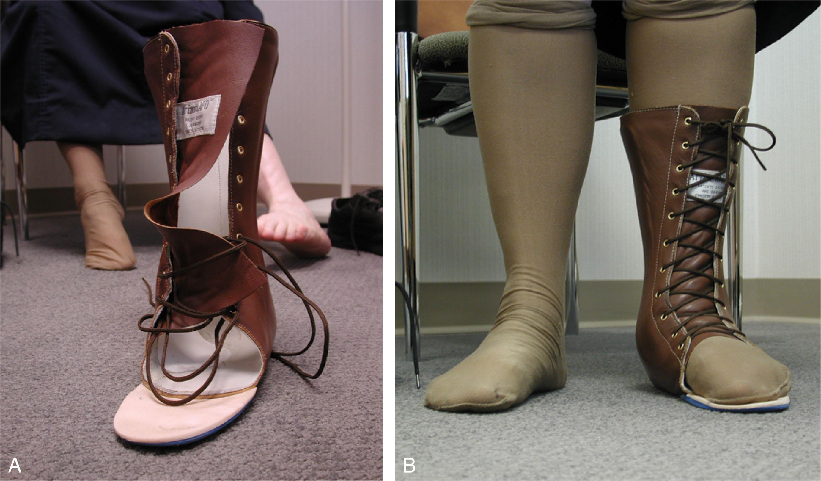 Fig. 29-18, A , The Arizona brace is a lace up corset that crosses the ankle joint to provide increased stability preventing collapse of the medial column. B , Clinical use of the Arizona brace.