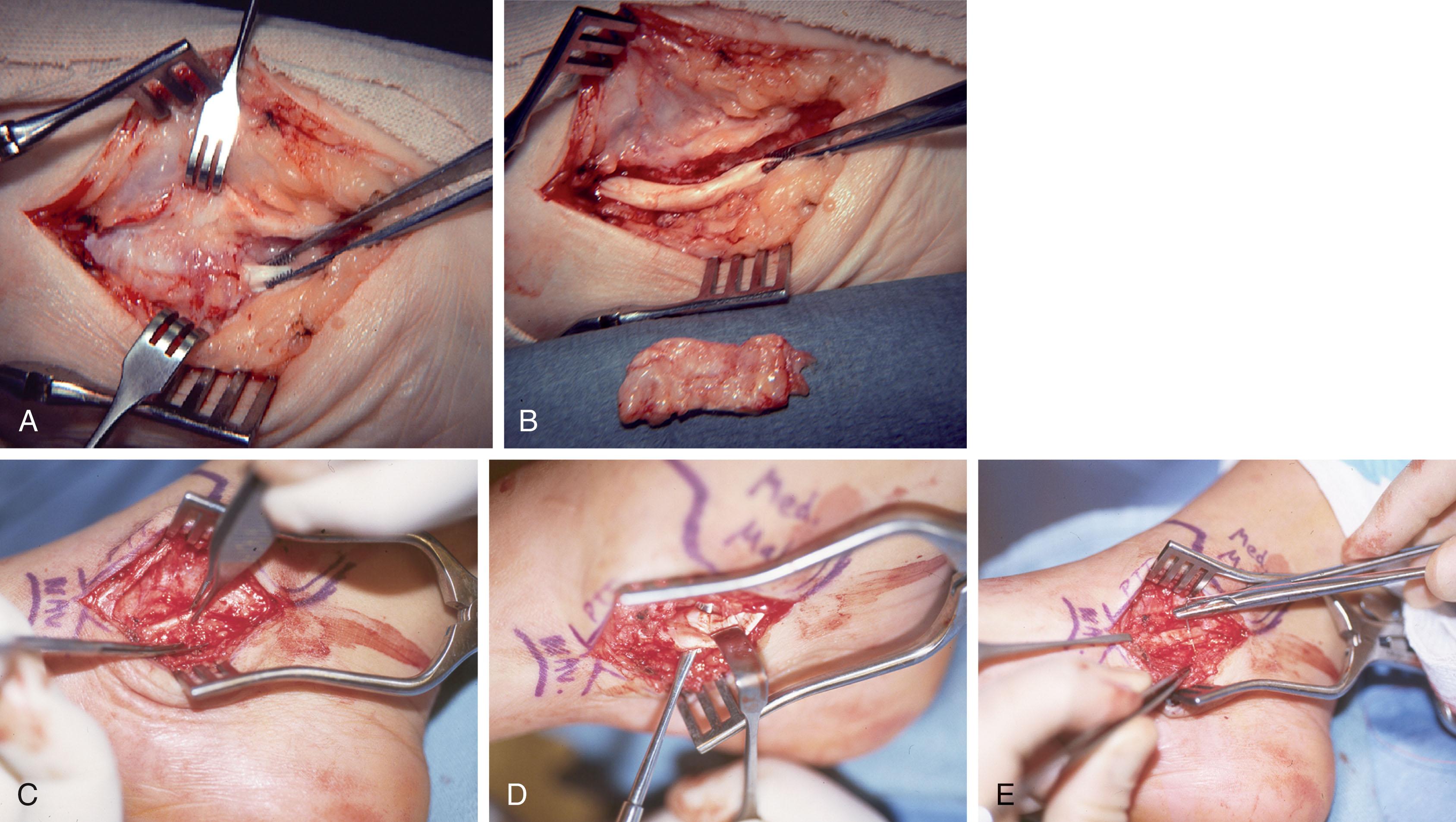 Fig. 29-20, Synovitis of the posterior tibial tendon. A , Severe synovial proliferation about the posterior tibial tendon. Forceps are on the tendon. B , Appearance of the tendon after synovectomy. Synovial tissue that was encircling the tendon is below the wound. C , Less significant synovitis can still reveal disease beneath the inflamed tissue, as this tenosynovectomy illustrates. D , The surgeon must inspect the undersurface of the tendon for a longitudinal split tear. E , This type of split tear is repaired by tubularizing the tendon at the site of the defect.