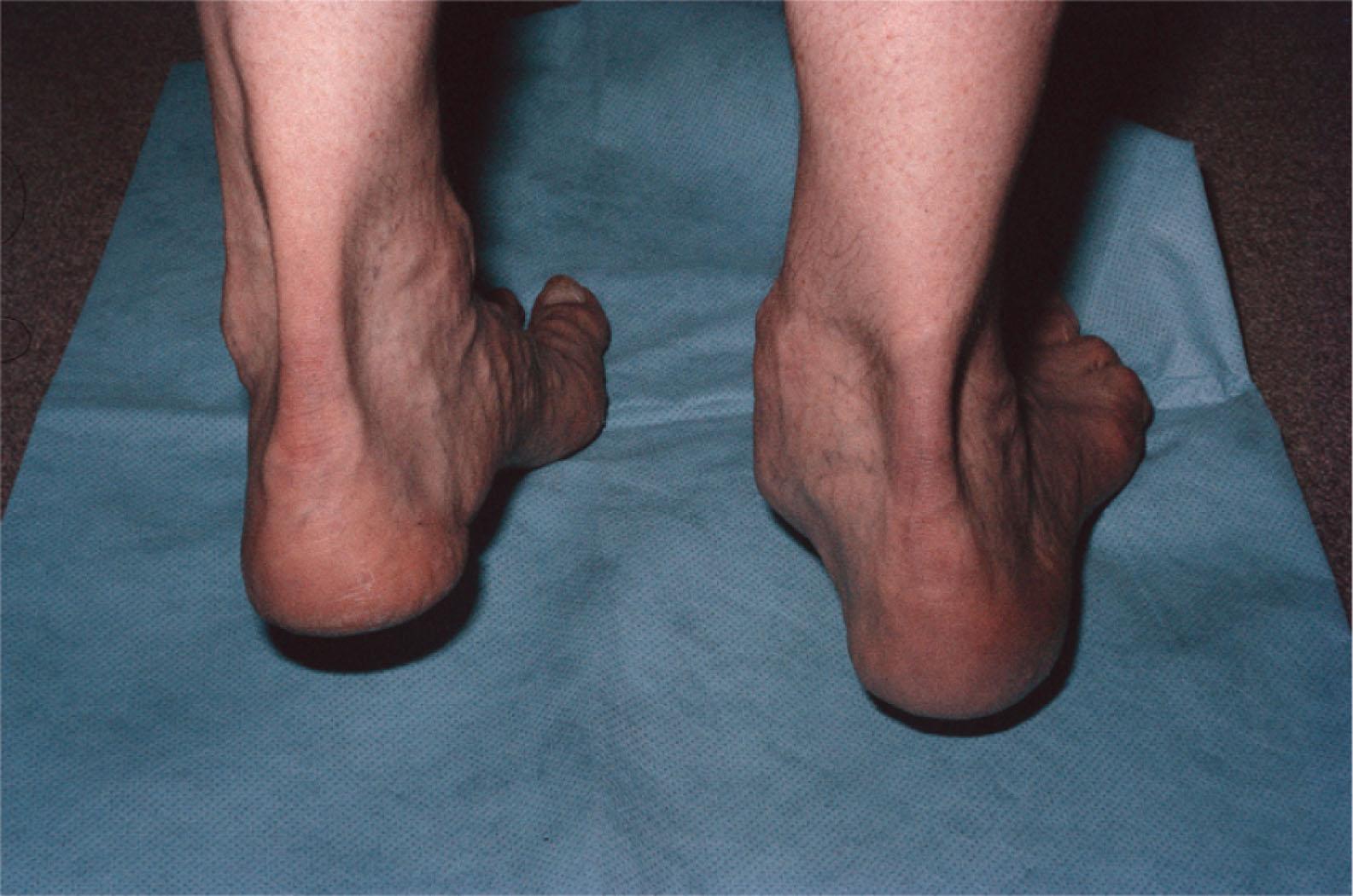 Fig. 29-2, Double and single toe rise is an integral part of the physical examination. Note that on the involved (right) side, inversion of the subtalar does not occur.