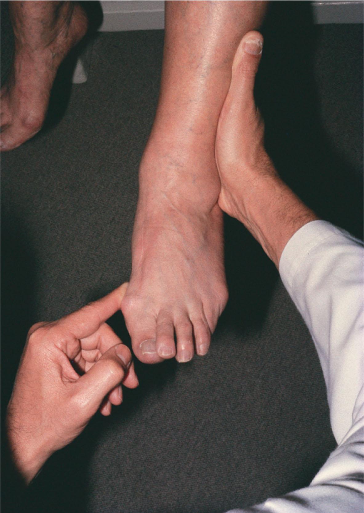 Fig. 29-3, Evaluation of posterior tibial tendon function. The foot is placed into full inversion and some plantar flexion, and the patient is asked to resist pressure from the examiner's finger.