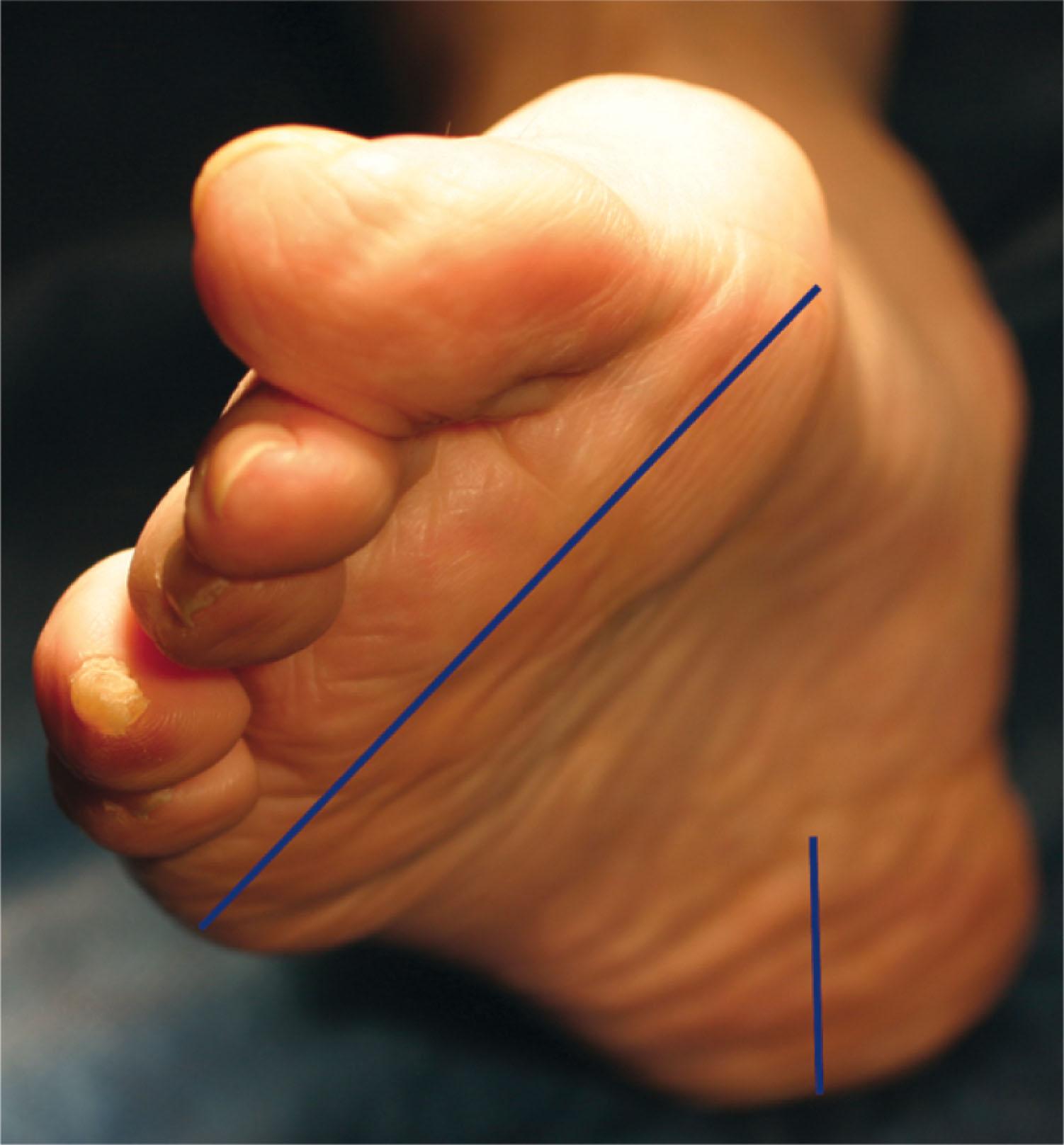 Fig. 29-4, Demonstration of forefoot varus. The degree of forefoot varus is determined by placing the heel in neutral position, covering the head of the talus with the navicular, and then observing the relationship of the metatarsal heads to the neutral hindfoot. In fixed forefoot varus, the lateral border of the foot is more plantar flexed than the medial border.
