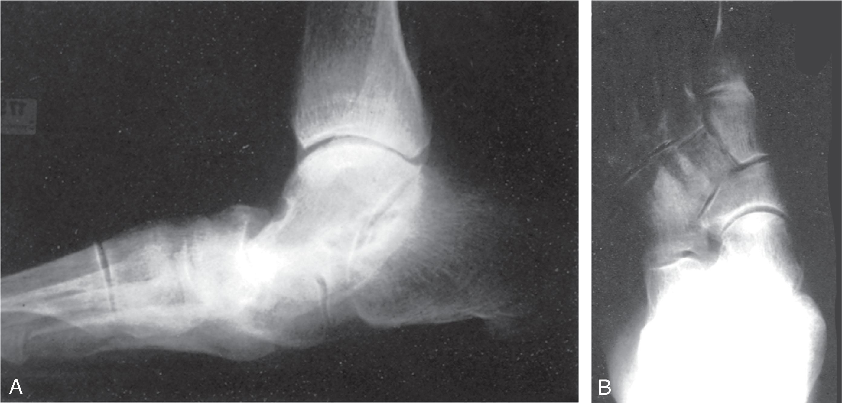 Fig. 29-5, Radiographic findings associated with posterior tibial tendon dysfunction. A and B , Radiographs demonstrate significant talonavicular sag in the lateral radiograph and minimal abduction in the anteroposterior (AP) radiograph.