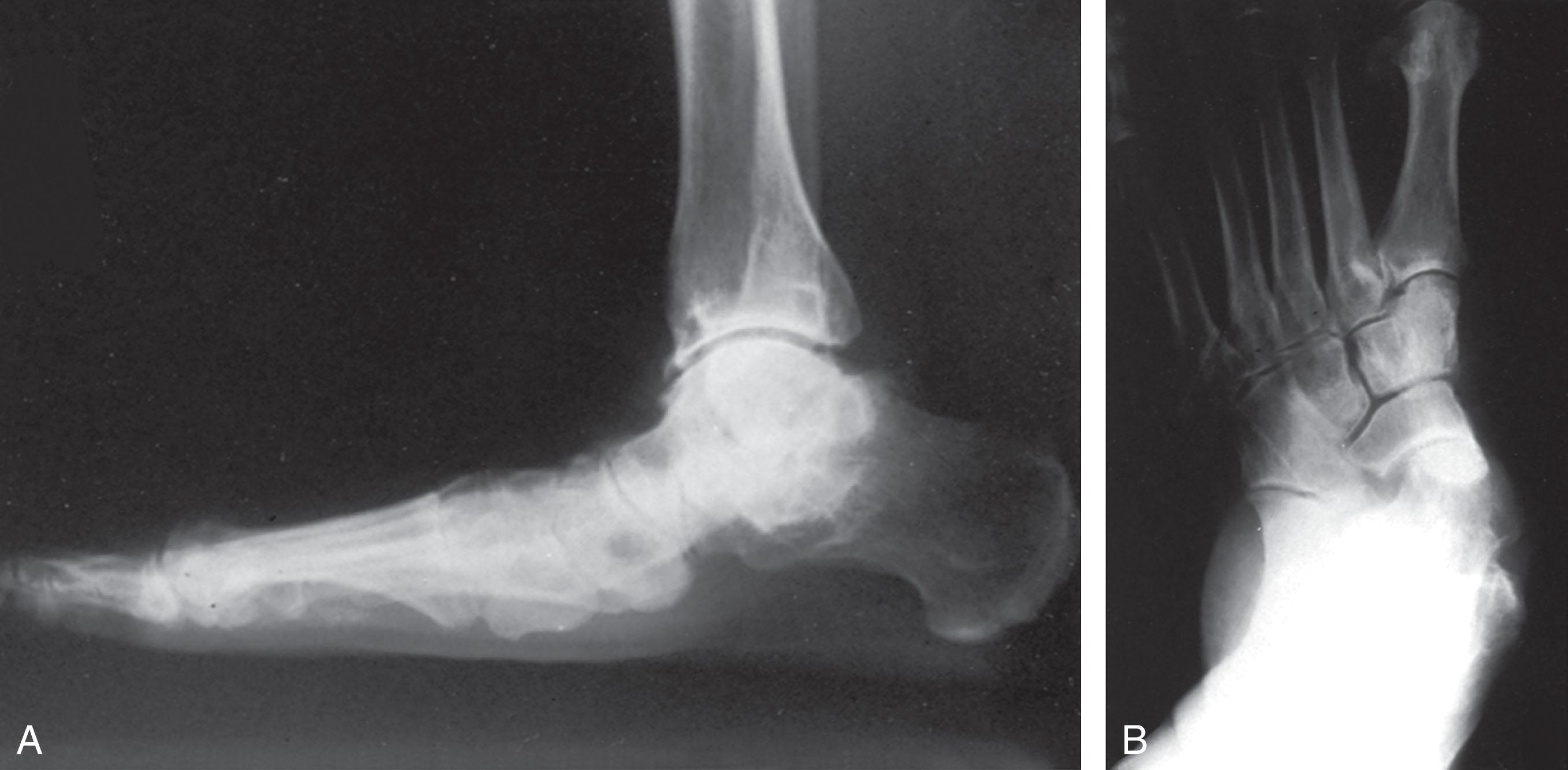 Fig. 29-6, Radiographic findings associated with posterior tibial tendon dysfunction. A and B , Radiographs demonstrate minimal sag at the talonavicular joint on the lateral radiograph yet significant abduction on the anteroposterior (AP) radiograph.