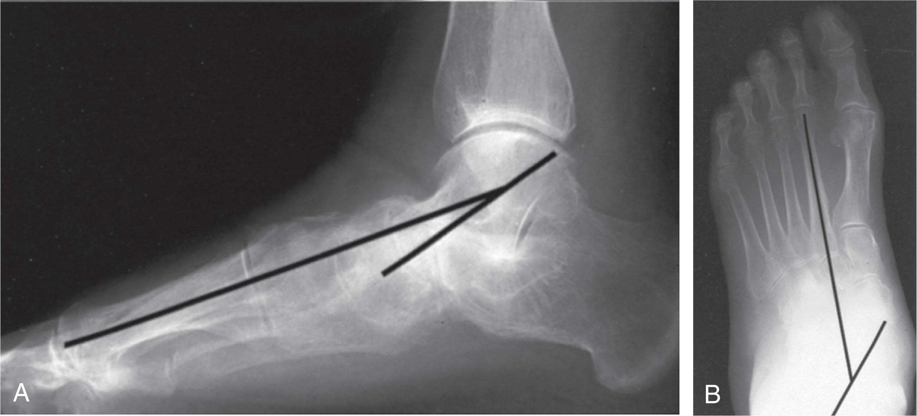 Fig. 29-7, Radiographic findings associated with posterior tibial tendon dysfunction. A and B , Moderate degree of sagging of the talonavicular joint in the lateral radiograph and abduction on the anteroposterior (AP) radiograph.