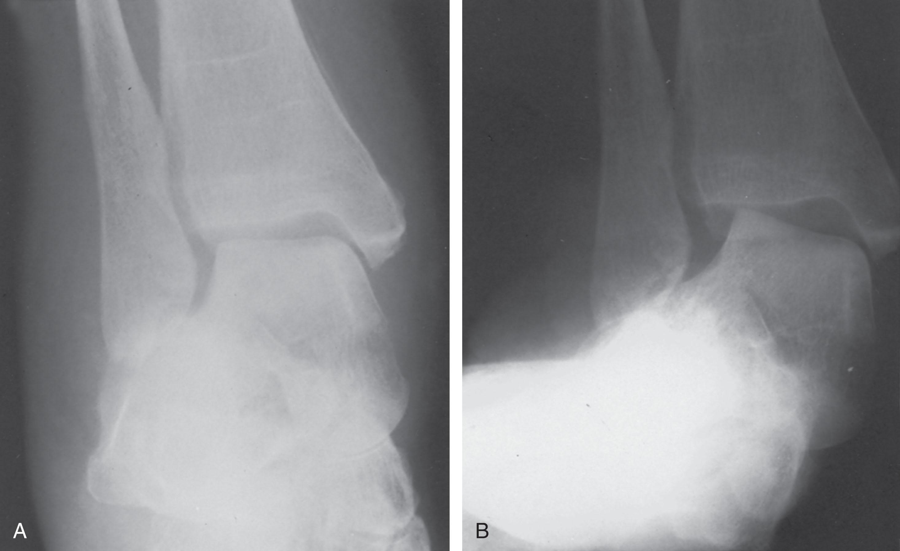 Fig. 29-8, Ankle joint changes associated with posterior tibial tendon dysfunction. A , Anteroposterior (AP) non–weight-bearing radiograph of the ankle joint demonstrating slight talar tilt. B , Weight-bearing radiograph demonstrating significant valgus tilt associated with a marked valgus deformity of the calcaneus.