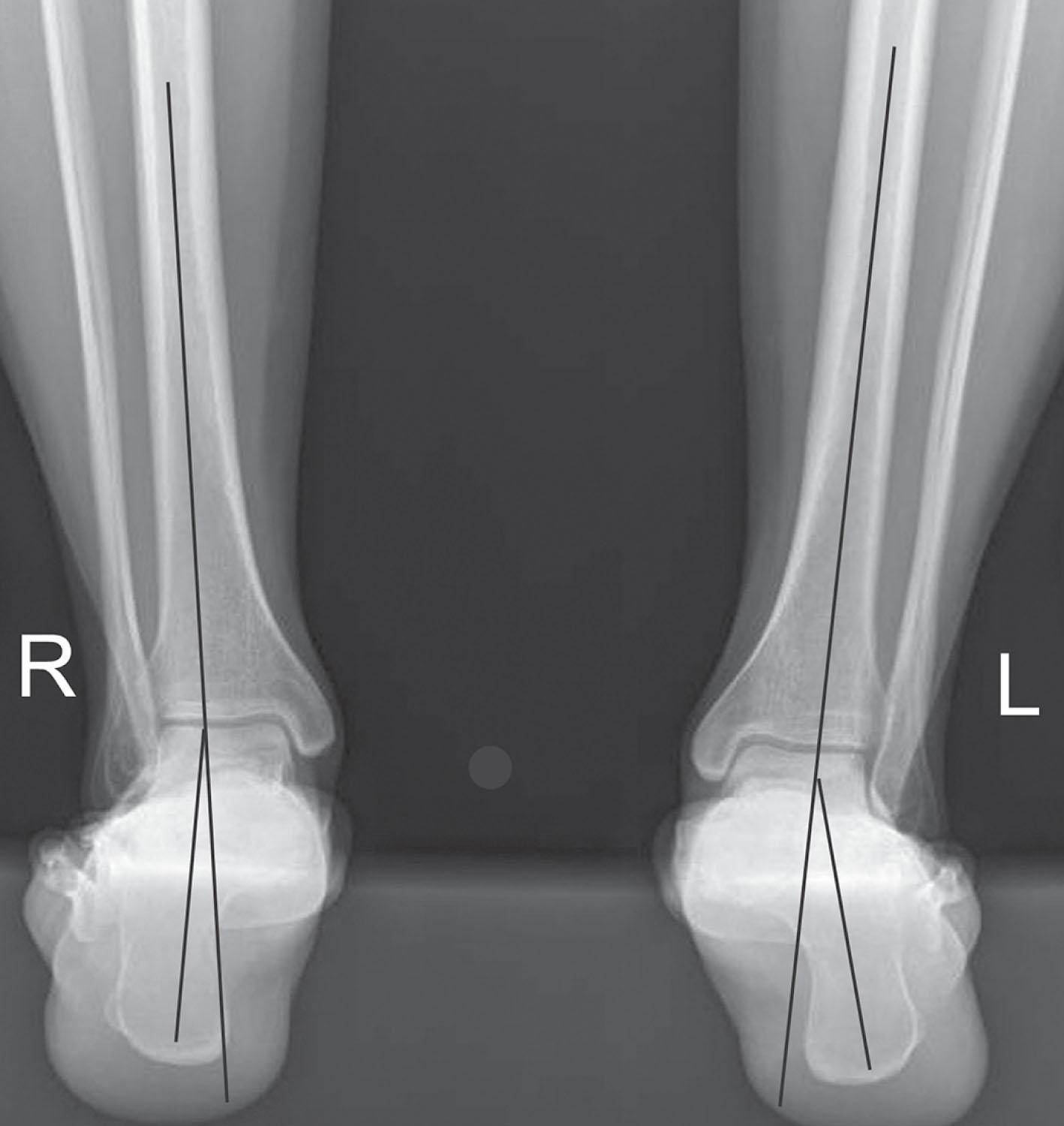 Fig. 29-9, Axial radiograph of the hindfoot alignment view. This radiographic view is useful in determining the magnitude of valgus hindfoot deformity and thus planning the appropriate surgical intervention. The left hindfoot shows increased hindfoot valgus compared with the right.