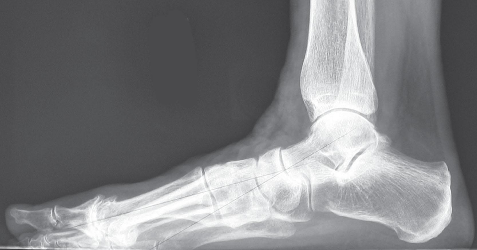 Fig. 29-10, Radiographic findings associated with posterior tibial tendon dysfunction. Minimal changes at the talonavicular joint but plantar gapping at the first tarsometatarsal joint is seen.