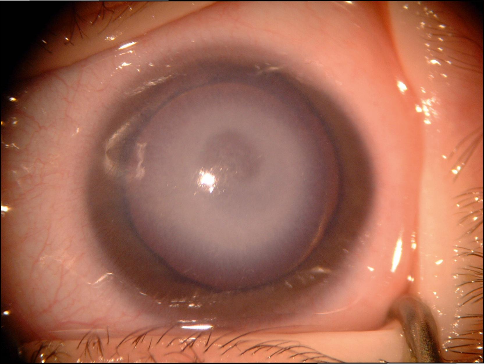 Fig. 57.1, A photograph of patient with Peters anomaly demonstrating a central white opacity (leukoma) in the cornea.