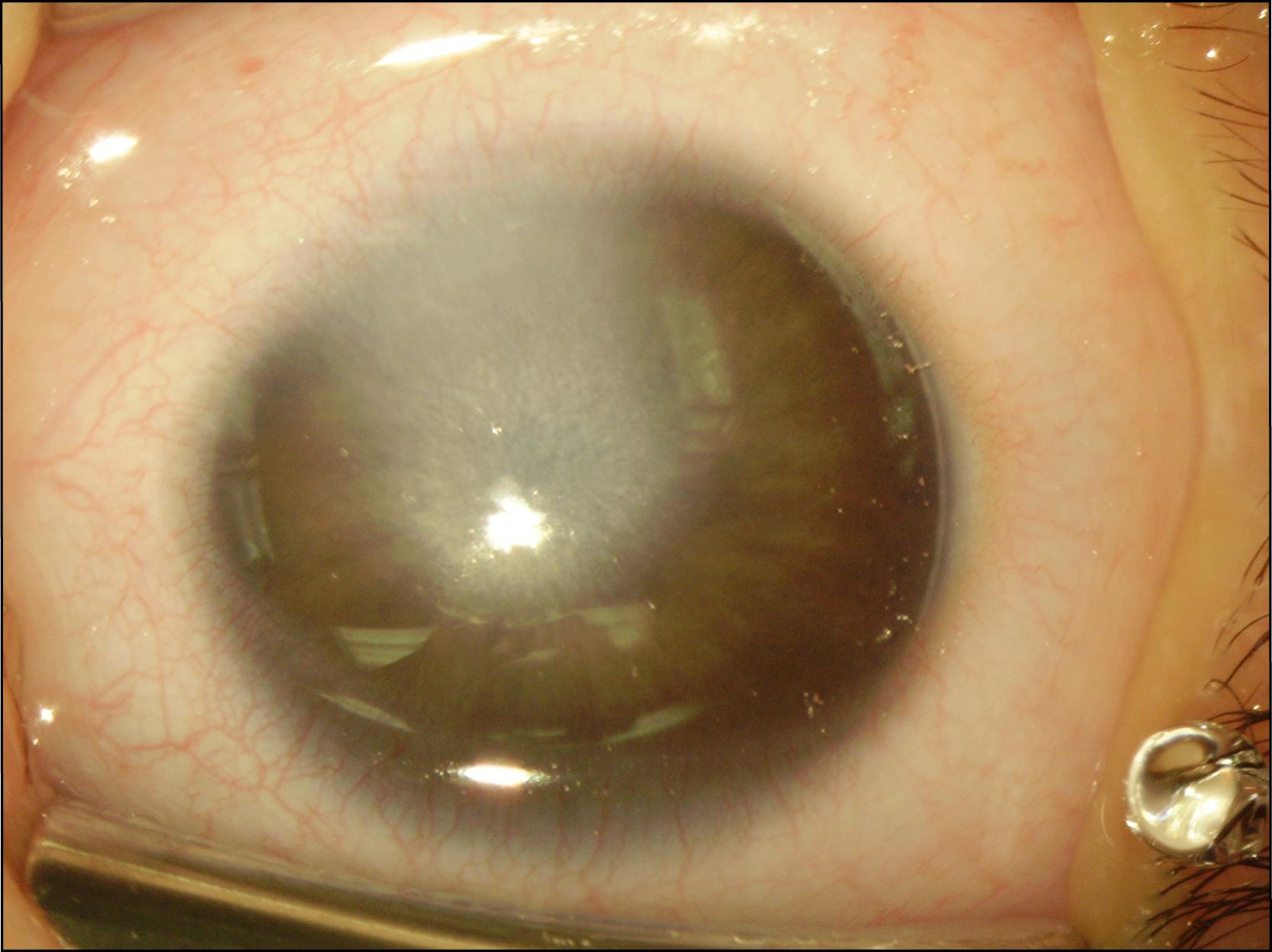 Fig. 57.2, Peters anomaly showing moderate opacification of the cornea. There is also a superficial vascular pannus.