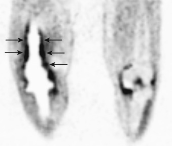 Figure 77-1, Knee joint prosthesis infection on FDG PET. Note asymmetrically increased FDG uptake along interfaces of right knee joint prosthesis and bone ( arrows ). Incidental FDG uptake in and around left knee joint is inflammatory in nature due to osteoarthritis and synovitis.