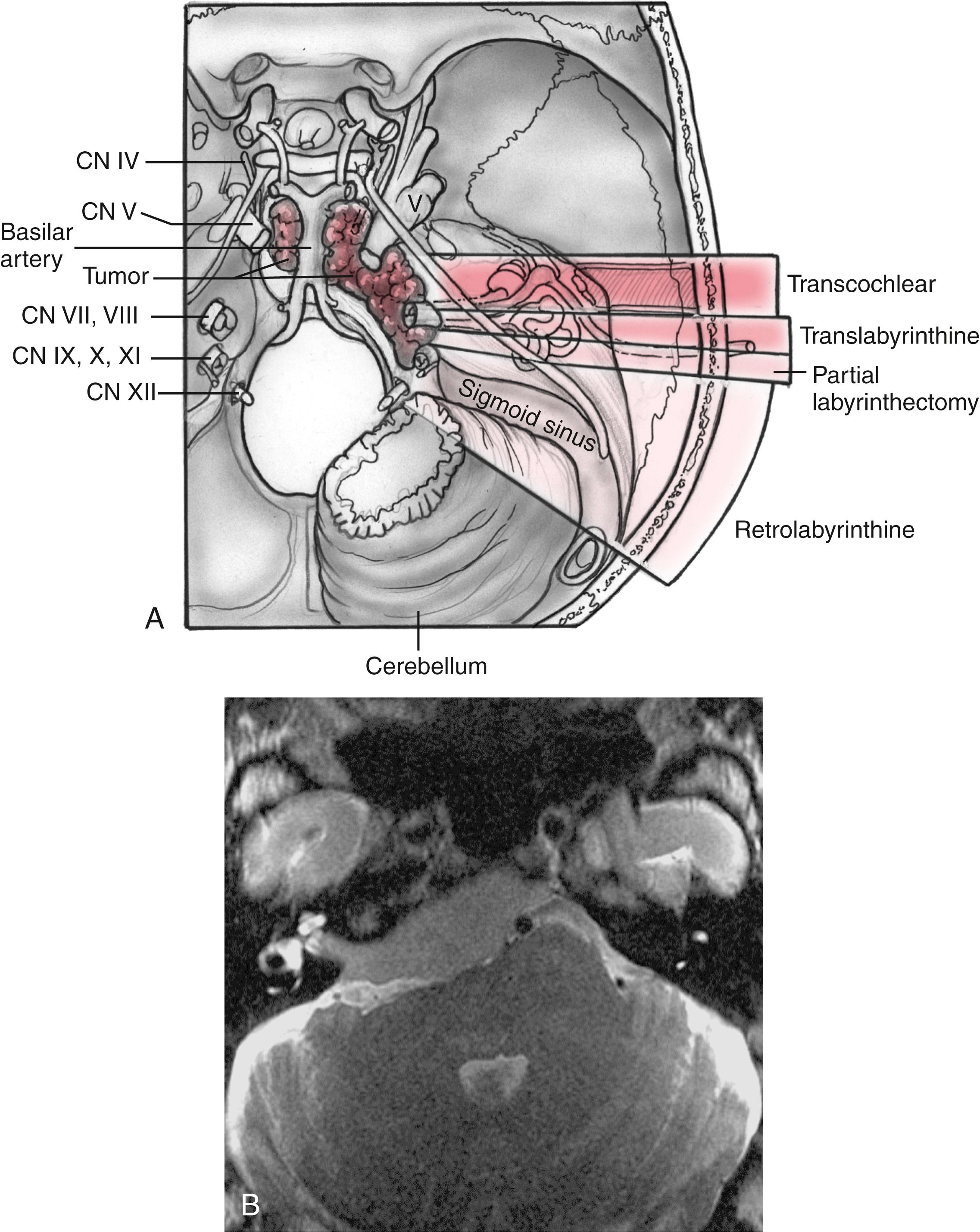 Fig. 51.1, (A) Four variations of the posterior approach provide unique exposure of the anterior and medial petrous bone by changing the angle of visualization across the brainstem. The retrolabyrinthine variation allows access to the petroclival junction, but limited medial access. Partial labyrinthectomy allows exposure up to the lateral aspect of the clival depression. Total labyrinthectomy allows exposure of the anterior brainstem and central clival depression. The transcochlear approach allows access to the contralateral portion of the clivus as well. (B) A large petroclival meningioma. Posterior compression of the brainstem keeps the angle of approach flat, and it allows the translabyrinthine approach despite contralateral clival involvement.