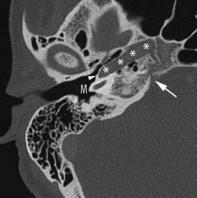 Fig. 11.2, Location of Neurovascular Channels Within the Petrous Apex.