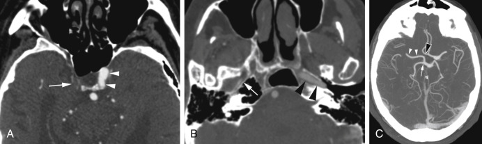 Fig. 11.4, Congenital Aplasia of the Internal Carotid Artery (ICA).