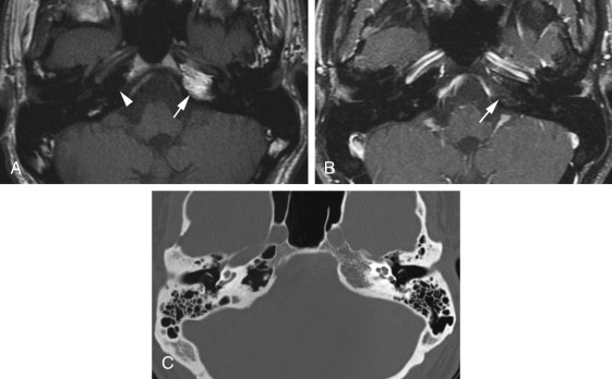 Fig. 11.5, Asymmetric Pneumatization of the Petrous Apex Mimicking Pathology.