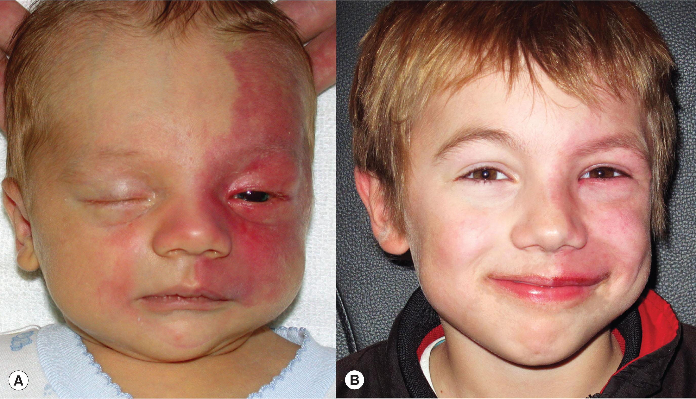 Fig. 68.1, (A) Sturge–Weber syndrome. Facial capillary malformation (“port wine stain”) at age 1 month and (B) at age 8 years following multiple dye laser sessions.