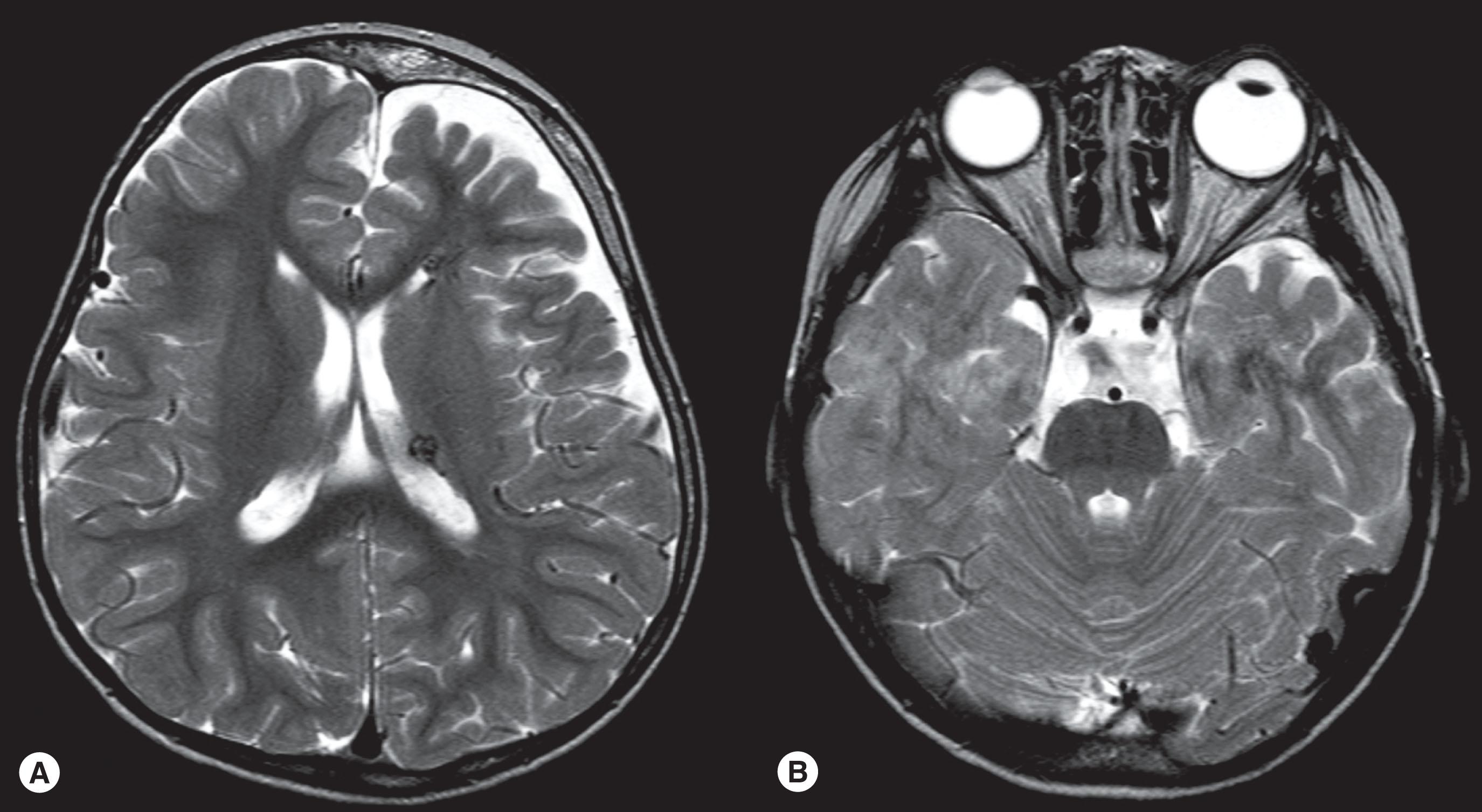 Fig. 68.2, (A) Leptomeningeal enhancement demonstrating the angiomatosis. Associated cerebral atrophy (post gadolinium T2 axial MRI scan). (B) Left temporal lobe leptomeningeal angiomatosis, cortical atrophy with calvarial skull bone thickening and left buphthalmos (T2 axial MRI image).