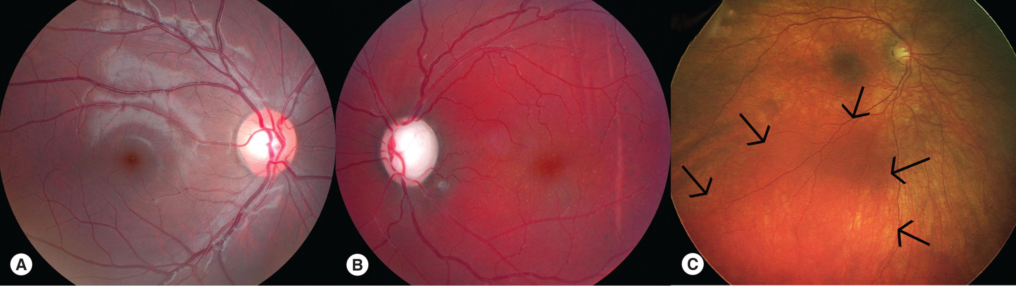 Fig. 68.3, Choroidal vascular malformation. (A) Normal right eye. (B) Diffuse posterior pole involvement (“tomato ketchup fundus”) in the same patient. (C) Circumscribed posterior pole choroidal vascular malformation (Retcam image).