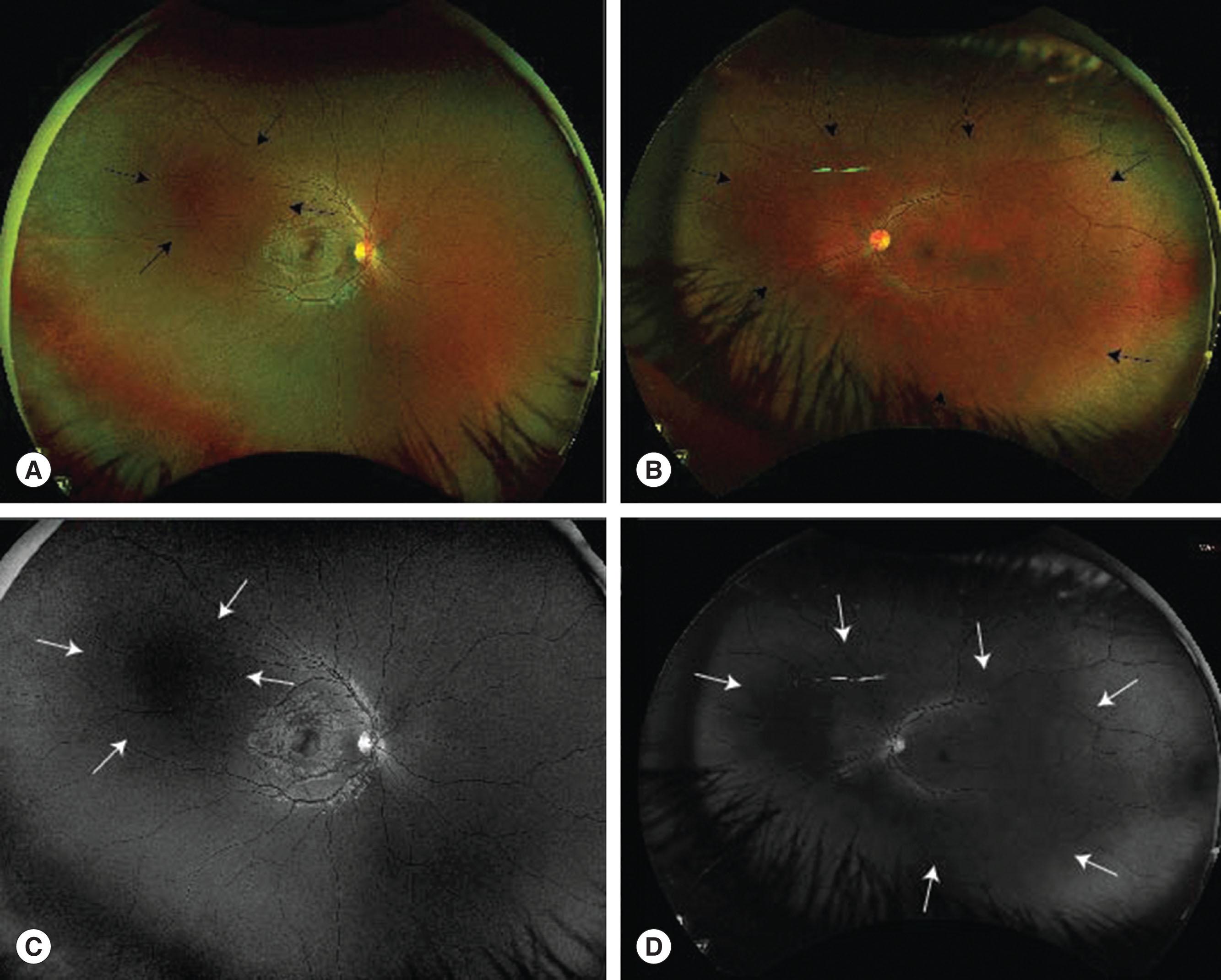 Fig. 68.4, Bilateral choroidal vascular malformations. (A) Right eye focal lesion temporal macula. (B) Left large lesion occupying two-thirds of fundus. Wide-field imaging with false colorization may make visualizing the extent of the choroidal malformations difficult. (Black arrows mark anterior boundary of choroidal vascular malformation.) (C–D) The wide-field fundus autofluorescence assists in confirming the locations. (White arrows mark anterior boundary of choroidal vascular malformation.)