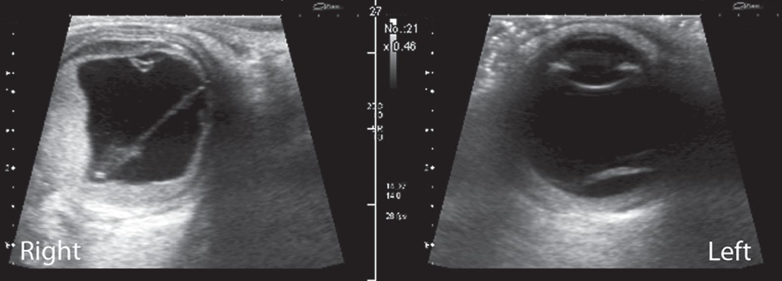 Fig. 68.5, Ultrasound of choroidal vascular malformations (“hemangioma”) with associated exudative retinal detachment almost complete in the right eye and localized in the left eye.