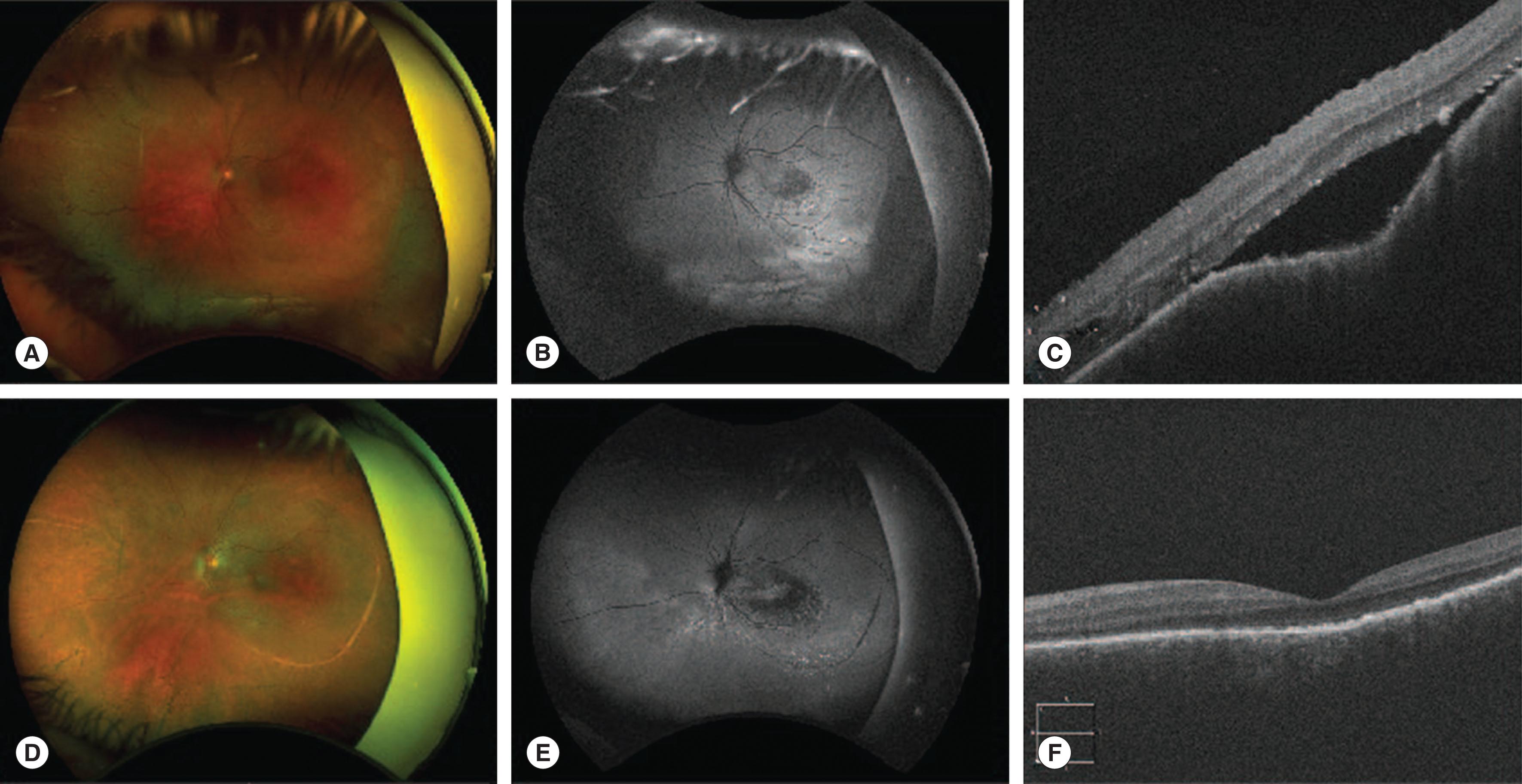 Fig. 68.6, Wide-field color, fundus autofluorescence, and OCT serous retinal detachment associated with choroidal vascular malformation before (A–C) and after (D–F) external beam radiotherapy.