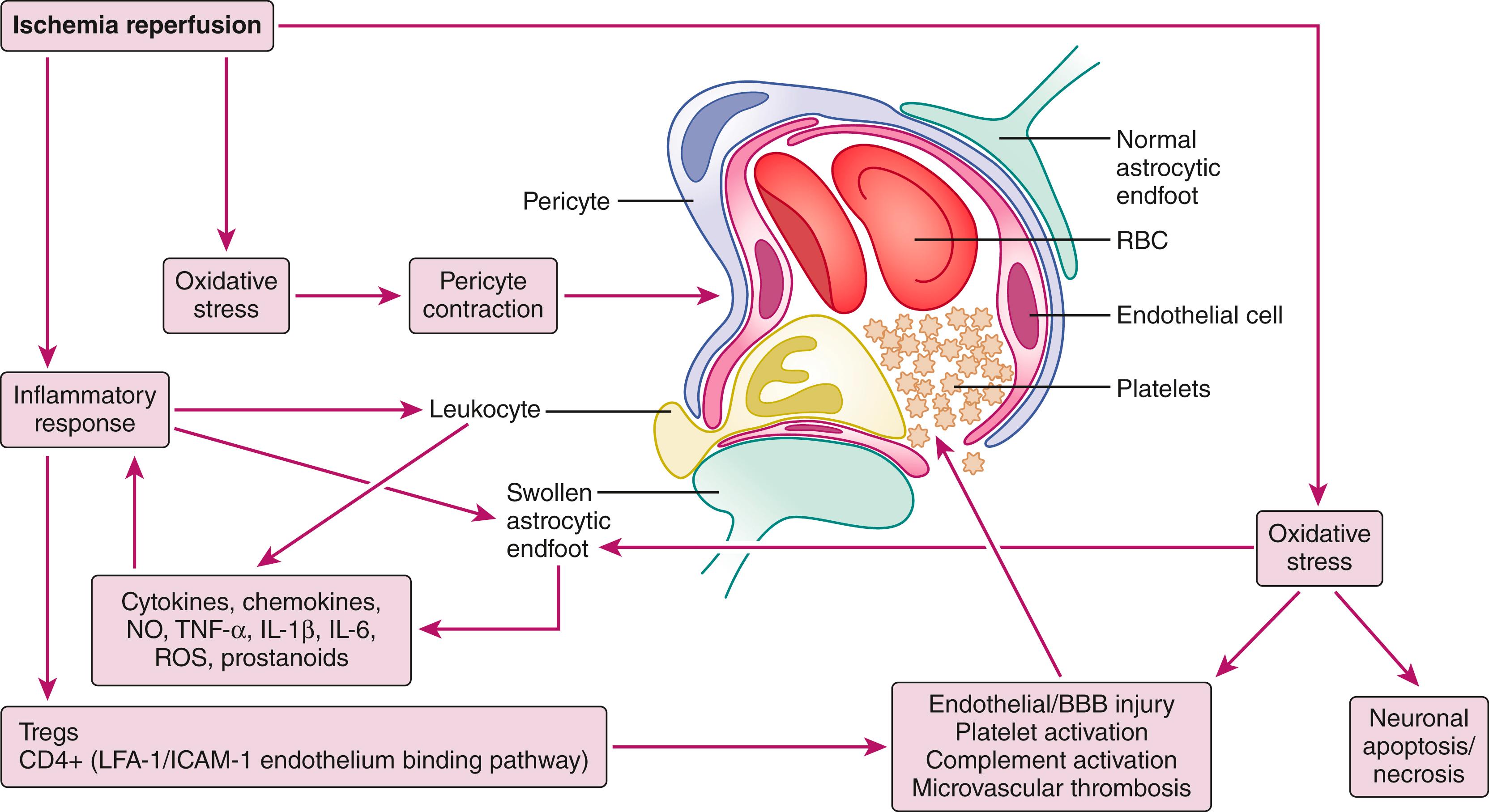 Fig. 57.1, Schematic model of neurovascular mechanism of post-ischemic reperfusion injury. During reperfusion after ischemia, overproduction of reactive oxygen species (ROS) causes oxidative stress. The oxidative stress damages the endothelial cells, resulting in an exposure of the subendothelial extracellular matrix to blood flow. The exposure triggers adhesion and activation of platelets in microvasculature causing thrombosis. The injured endothelial cells release metalloproteinase that attacks basal lamina causing leakage of the blood-brain barrier (BBB) . The damaged endothelial cells interact with regulatory T cells and activated leukocytes to exacerbate intravascular thrombosis. In addition, a large amount of inflammatory factors including cytokines, chemokines, nitric oxide (NO), TNF-α, interleukin (IL)-1b, IL-6, ROS, and prostanoids are released from activated astrocytes and microglia. The ensuing inflammatory response causes a high degree of cytotoxicity that amplifies neuronal death in the penumbra. Furthermore, the oxidative stress causes sustained contraction of pericytes, which leads to narrowing of the microvasculature lumen. The luminal narrowing is further worsened by compression from swollen end feet of activated astrocytes. ICAM-1 , Intercellular adhesion molecule-1; LFA-1 , lymphocyte function-associated antigen-1; RBC , red blood cell; TNF-α , tumor necrosis factor alpha.