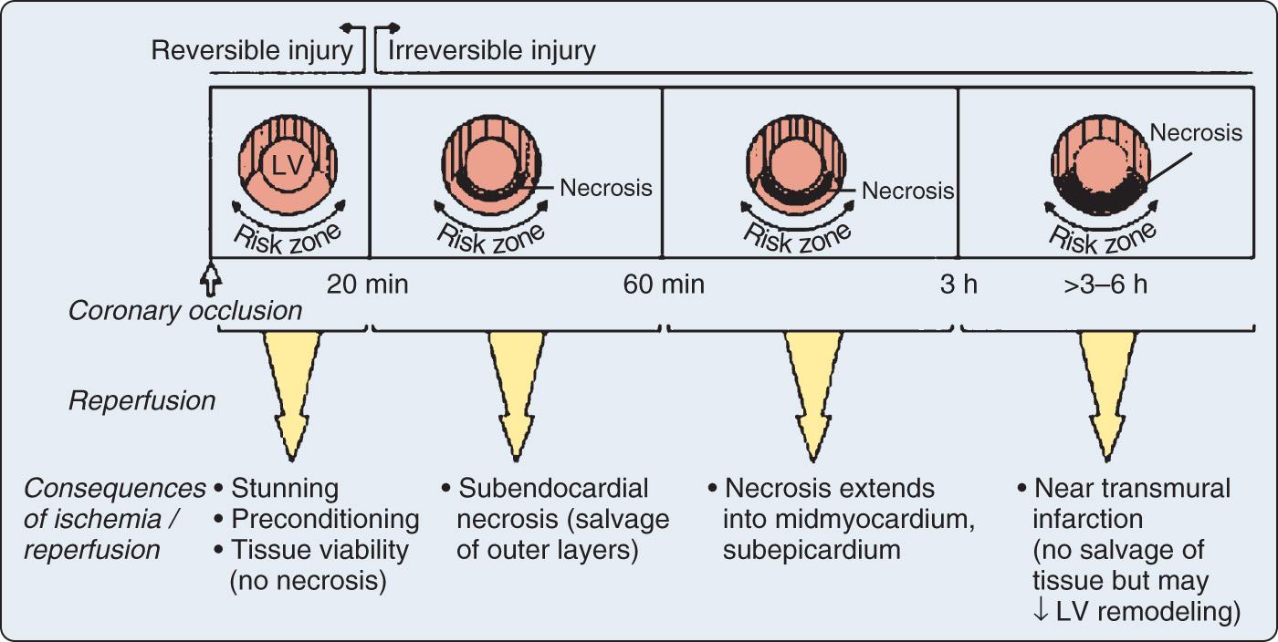 Fig. 7.1, Effects of ischemia and reperfusion on the heart based on studies using an anesthetized canine model of proximal coronary artery occlusion. Periods of ischemia of less than 20 minutes followed by reperfusion are not associated with development of necrosis (ie, reversible injury). Brief ischemia and reperfusion results in stunning and preconditioning. If the duration of coronary occlusion is extended beyond 20 minutes, necrosis develops from the subendocardium to subepicardium over time. Reperfusion before 3 hours of ischemia salvages ischemic but viable tissue. Salvaged tissue may demonstrate stunning. Reperfusion beyond 3 to 6 hours in this model does not reduce myocardial infarct size. Late reperfusion may still have a beneficial effect on reducing or preventing myocardial infarct expansion and left ventricular (LV) remodeling.