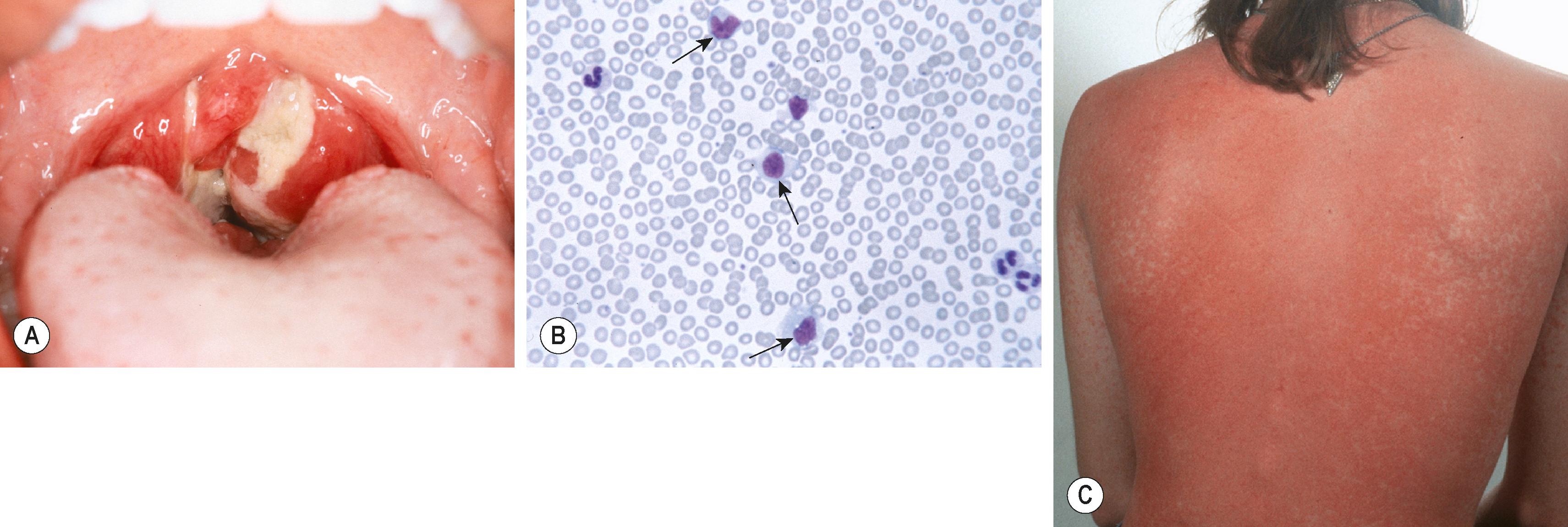 Figure 27.1, (A) Pharyngeal erythema and exudate due to Epstein-Barr virus (EBV) infection. (B) Peripheral blood smear shows atypical lymphocytes (arrows) in a patient with EBV mononucleosis. Notice the abundant cytoplasm with vacuoles and deformation of cell by surrounding cells. (C) Diffuse, erythematous, raised rash on an adolescent with EBV mononucleosis who received amoxicillin. Notice the predominance of exanthem on the trunk and coalescence of lesions.