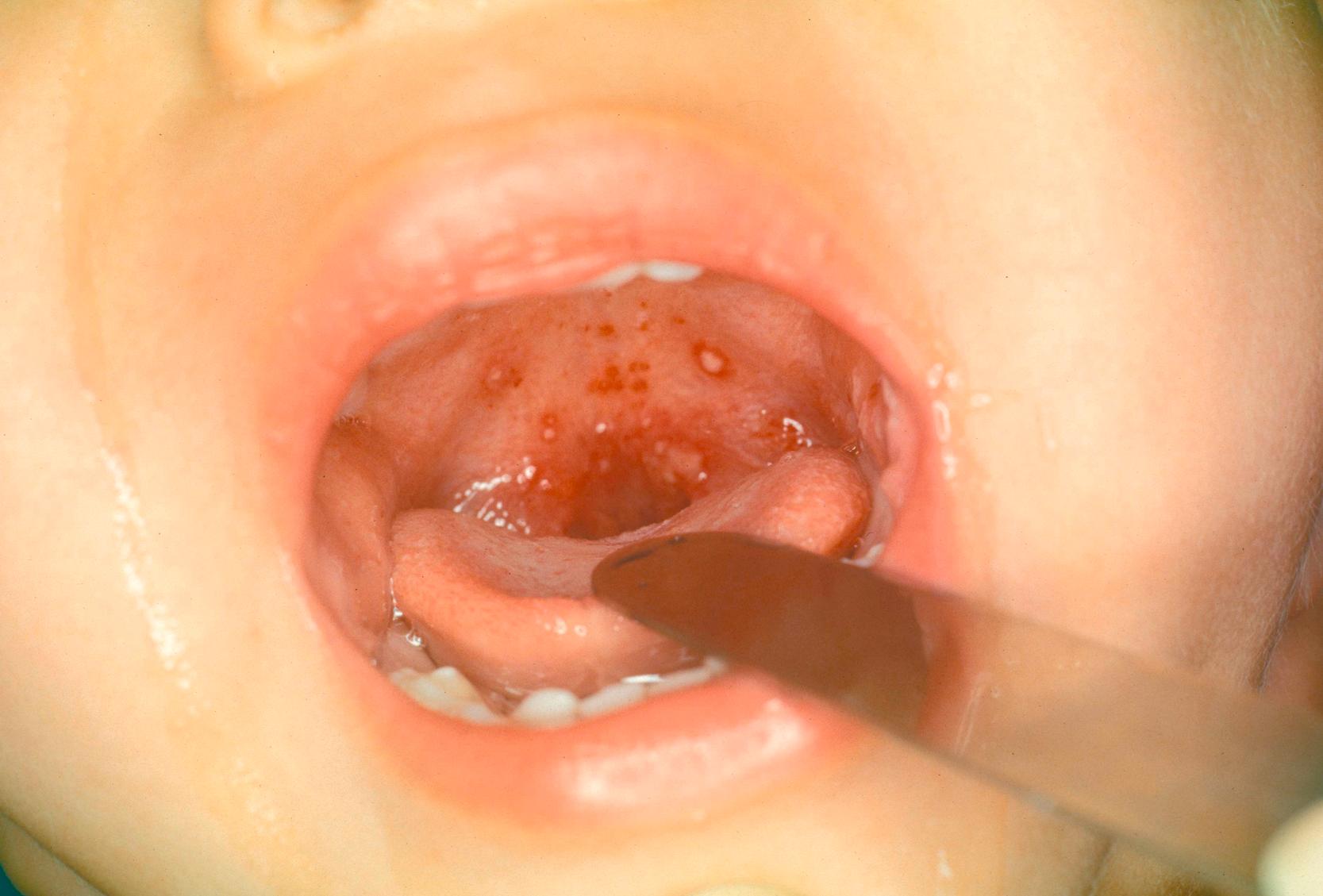 Figure 27.2, The child has posterior pharyngeal, gray-white, papulovesicular lesions characteristic of enteroviral herpangina.