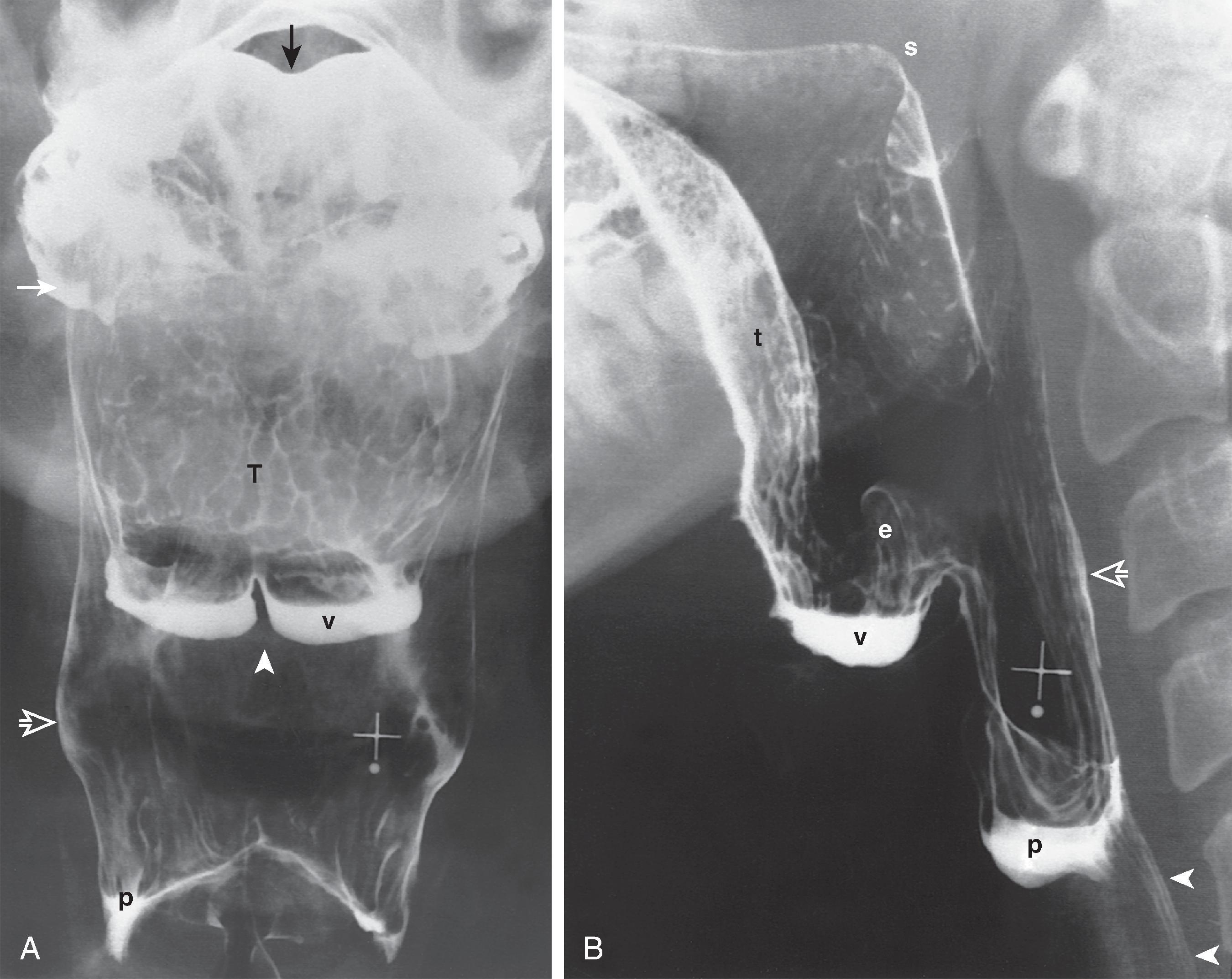 Fig. 4.1, Basic structures of the normal pharynx. (A) Double-contrast frontal view of the pharynx shows the contours of the superior surface of the tongue ( black arrow ), tonsillar fossa (right tonsillar fossa [ white arrow ]), valleculae (left vallecula [ v ]), and lateral wall ( open arrow ) of the piriform sinus (right piriform sinus [ p ]). The median glossoepiglottic fold ( arrowhead ) divides the space behind the tongue base into the two valleculae. The surface of the base of the tongue ( T ) has a reticular appearance en face because of the underlying lingual tonsil. (B) Double-contrast lateral view of the pharynx (during phonation) shows the contours of the soft palate ( s ), base of the tongue ( t ), epiglottis ( e ), valleculae ( v ), posterior pharyngeal wall ( open arrow ), lower piriform sinuses ( p ), and collapsed pharyngoesophageal segment ( arrowheads ). Note the height of the soft palate in relation to the C1 vertebral body and the thickness of the space behind the barium-coated pharyngeal mucosa, composed of pharyngeal musculature, fascial planes, prevertebral muscles, and anterior longitudinal ligament. (B, From Rubesin SE, Jones B, Donner MW. Contrast pharyngography: the importance of phonation. AJR. 1987;148:269–272.)