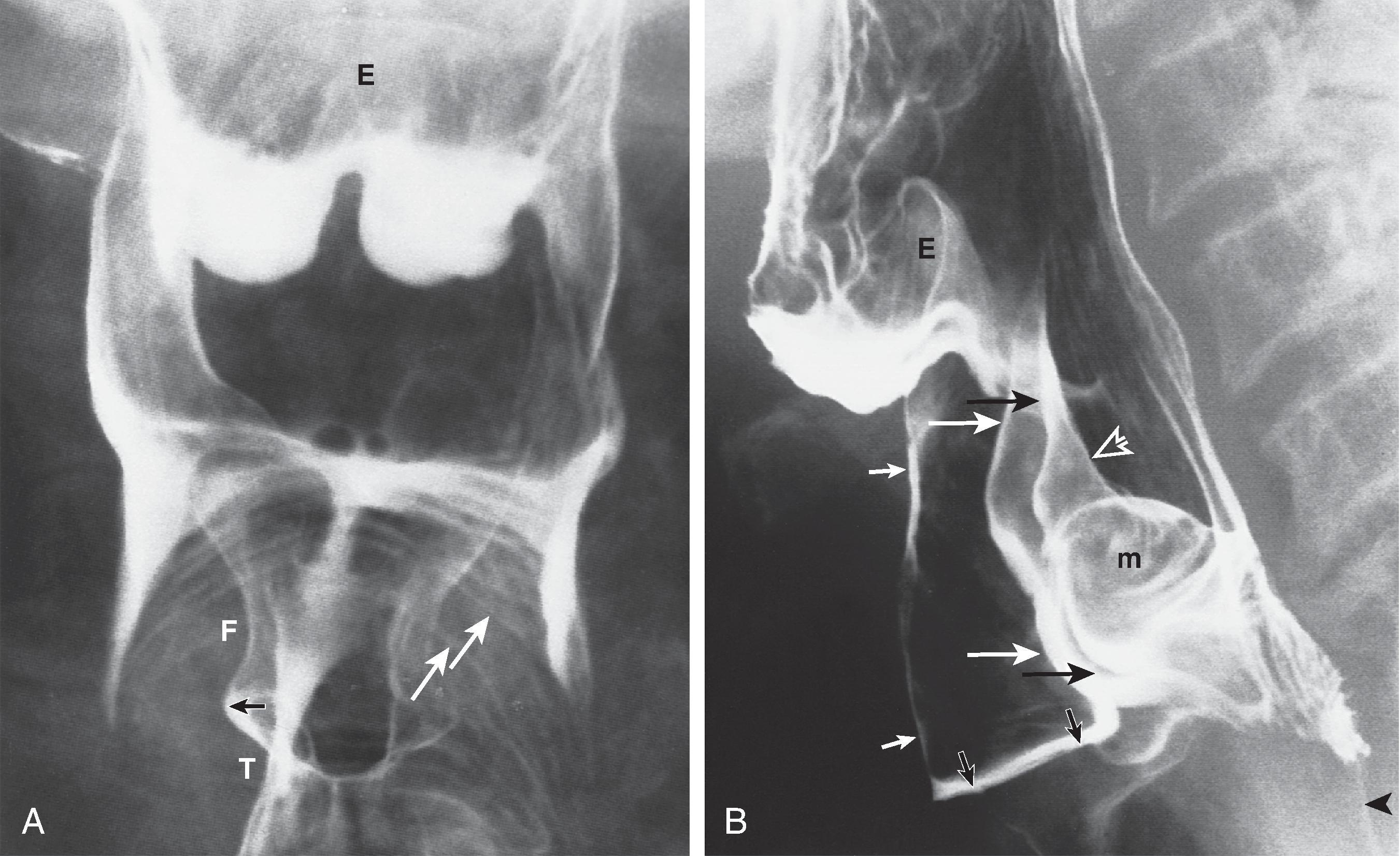 Fig. 4.2, Relationship of larynx to pharynx. (A) In a patient with laryngeal penetration, frontal view of the pharynx shows barium coating the false vocal cords (right false vocal cord [ F ]), true vocal cords (right true vocal cord [ T ]), and laryngeal ventricle (right laryngeal ventricle, black arrow ). As the larynx protrudes into the midhypopharynx, arcuate lines ( white arrows ) are formed. (B) Lateral view of the pharynx shows the relationship of the barium-coated laryngeal vestibule ( small white arrows ) to the laryngeal ventricle ( small black arrows ). Note the angle of the laryngeal ventricle atop the true vocal cords and tilt of the true vocal cords. The anterior walls of the right piriform sinus ( large white arrows ) and left piriform sinus ( arge black arrows ) are seen as anteriorly convex lines. The mucosa ( m ) overlying the muscular process of the arytenoid cartilages lies below the aryepiglottic fold ( open arrow ). The lower hypopharynx ( arrowhead ) is closed at rest. E, epiglottis. (B, From Rubesin SE, Glick SN. The tailored double-contrast pharyngogram. Crit Rev Diagn Imaging. 1988;28:133–179.)