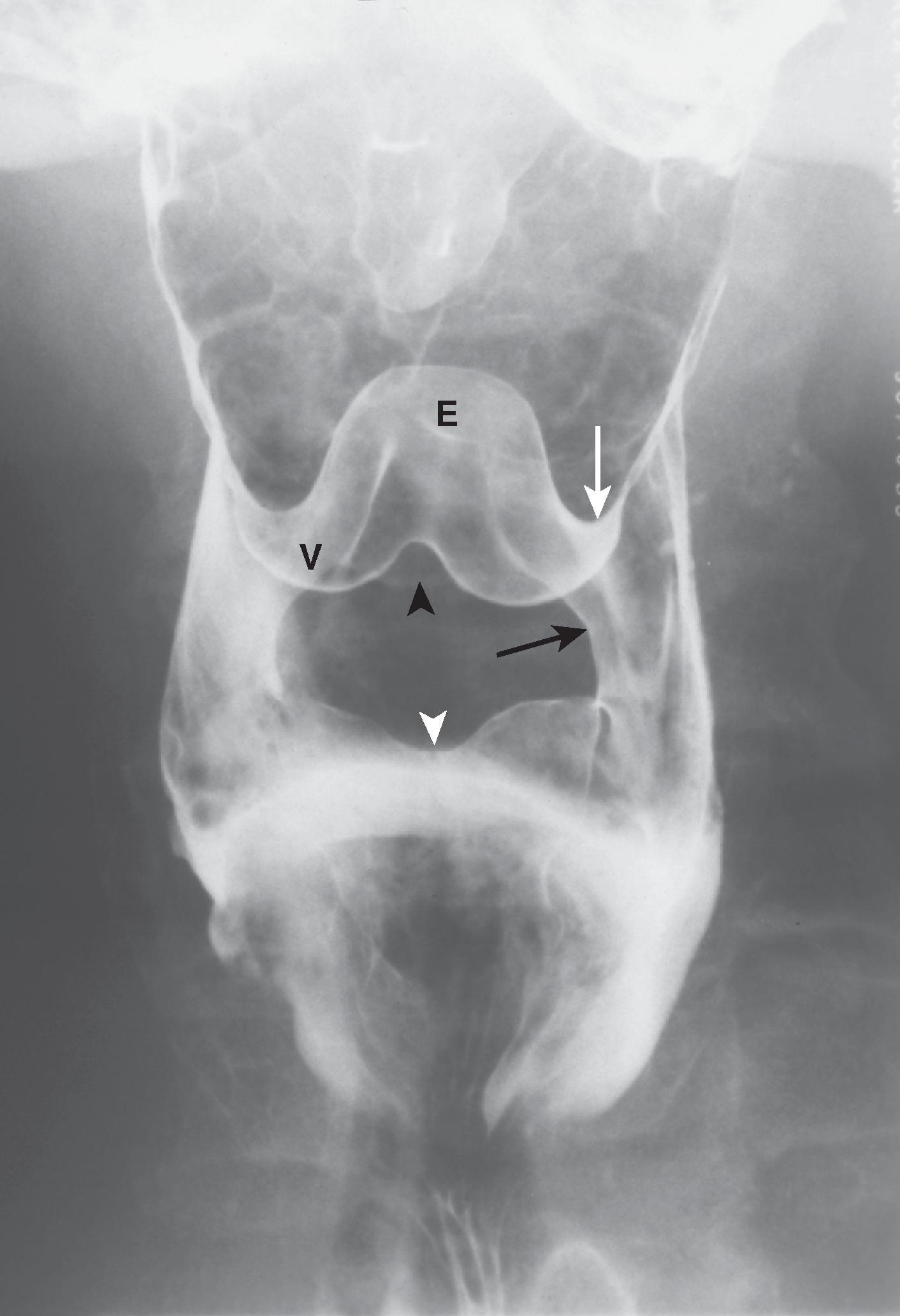 Fig. 4.3, Folds of the valleculae. Frontal view of the pharynx shows how the folds of the epiglottis and valleculae are accentuated by edema in a patient with chronic radiation change. The median glossoepiglottic fold ( black arrowhead ) divides the retroglottic space into the two valleculae (right vallecula [ V ]). The pharyngoepiglottic folds ( white arrow identifies the left pharyngoepiglottic fold) overlie the paired stylopharyngeal muscles and form part of the posterior wall of the valleculae. The epiglottic tip ( E ) and left aryepiglottic fold ( black arrow ) are also seen. Barium coats the laryngeal surface of the epiglottis because of laryngeal penetration. The interarytenoid notch ( white arrowhead ) lies between the swollen mucosa overlying the muscular processes of the arytenoid cartilages.
