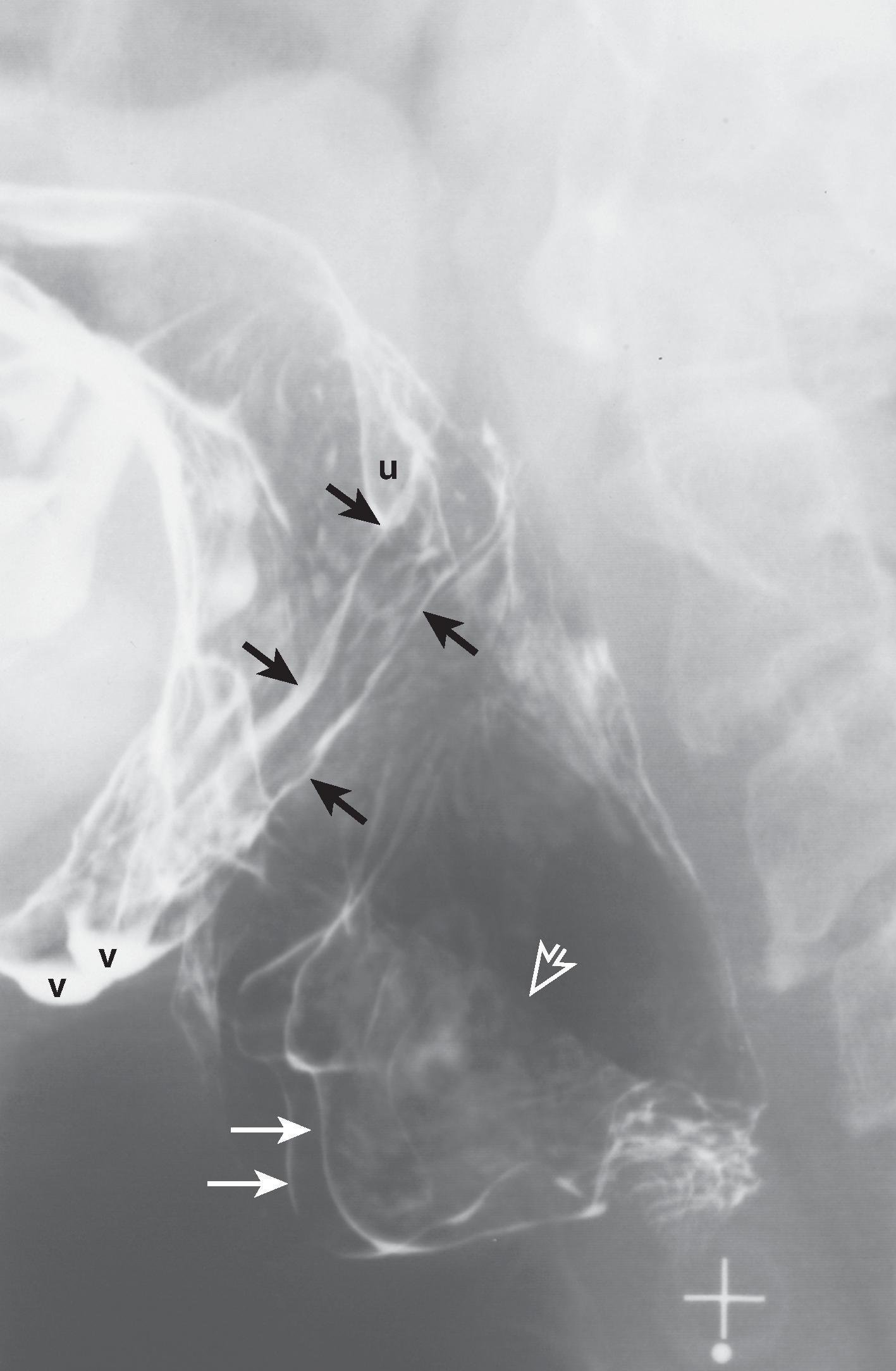Fig. 4.4, Pharyngoepiglottic folds. Lateral spot view of the pharynx shows paired pharyngoepiglottic folds ( black arrows ) coursing obliquely across the lateral wall of the pharynx. The pharyngoepiglottic fold overlies the stylopharyngeal muscle, which extends from the styloid process to the posterior wall of the valleculae ( v ). The uvular tip ( u ) is seen. The anterior walls of the piriform sinuses ( white arrows ) are well visualized. The mucosa overlying the muscular processes of the arytenoid cartilages ( open arrow ) is also seen.