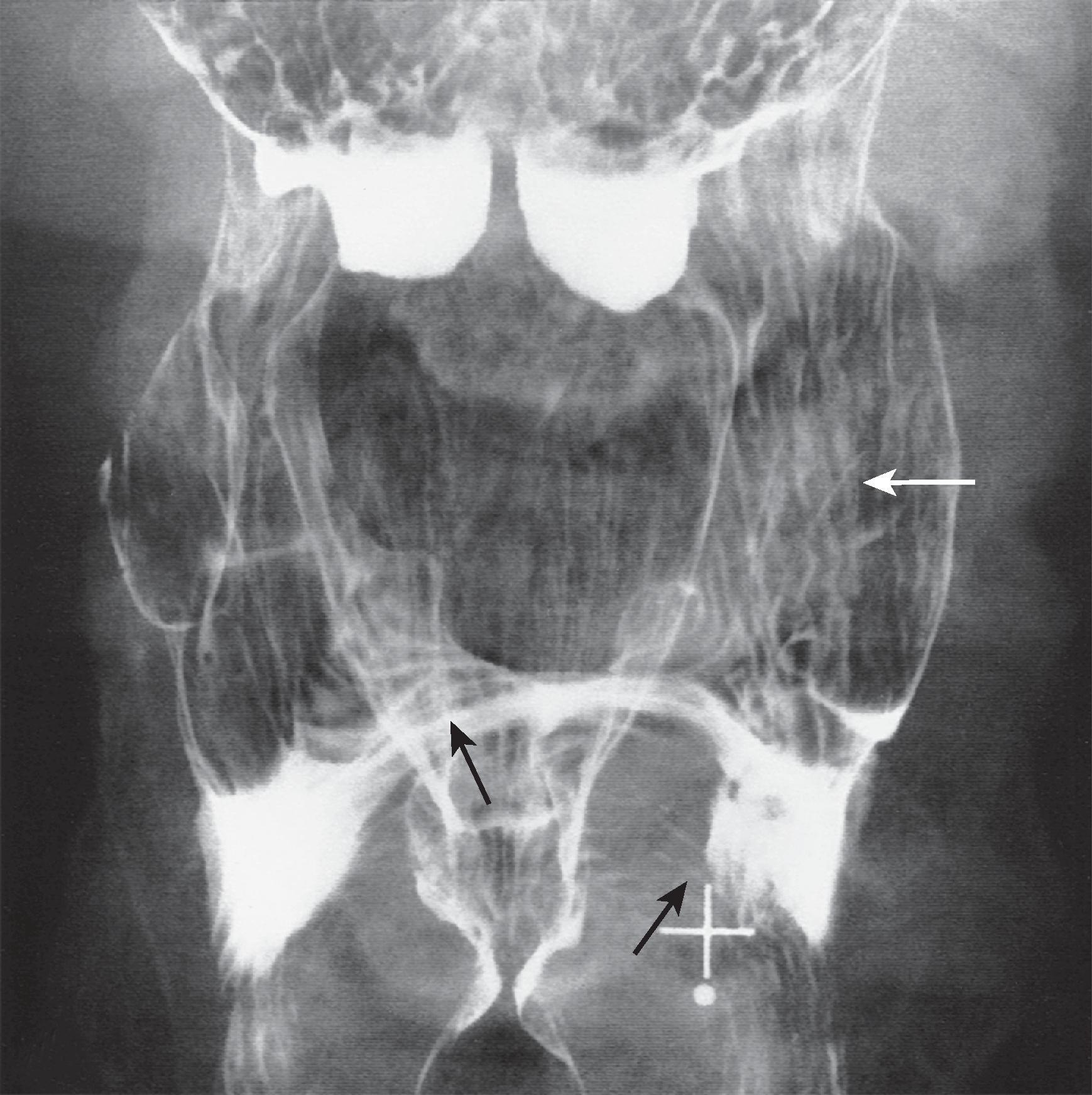 Fig. 4.5, Lines of the pharynx. The longitudinally striated mucosa ( white arrow ) reflects close apposition of the squamous mucosa to the underlying longitudinal muscle layer of the pharynx. Arcuate lines of the anterior hypopharyngeal wall are also identified ( black arrows ).