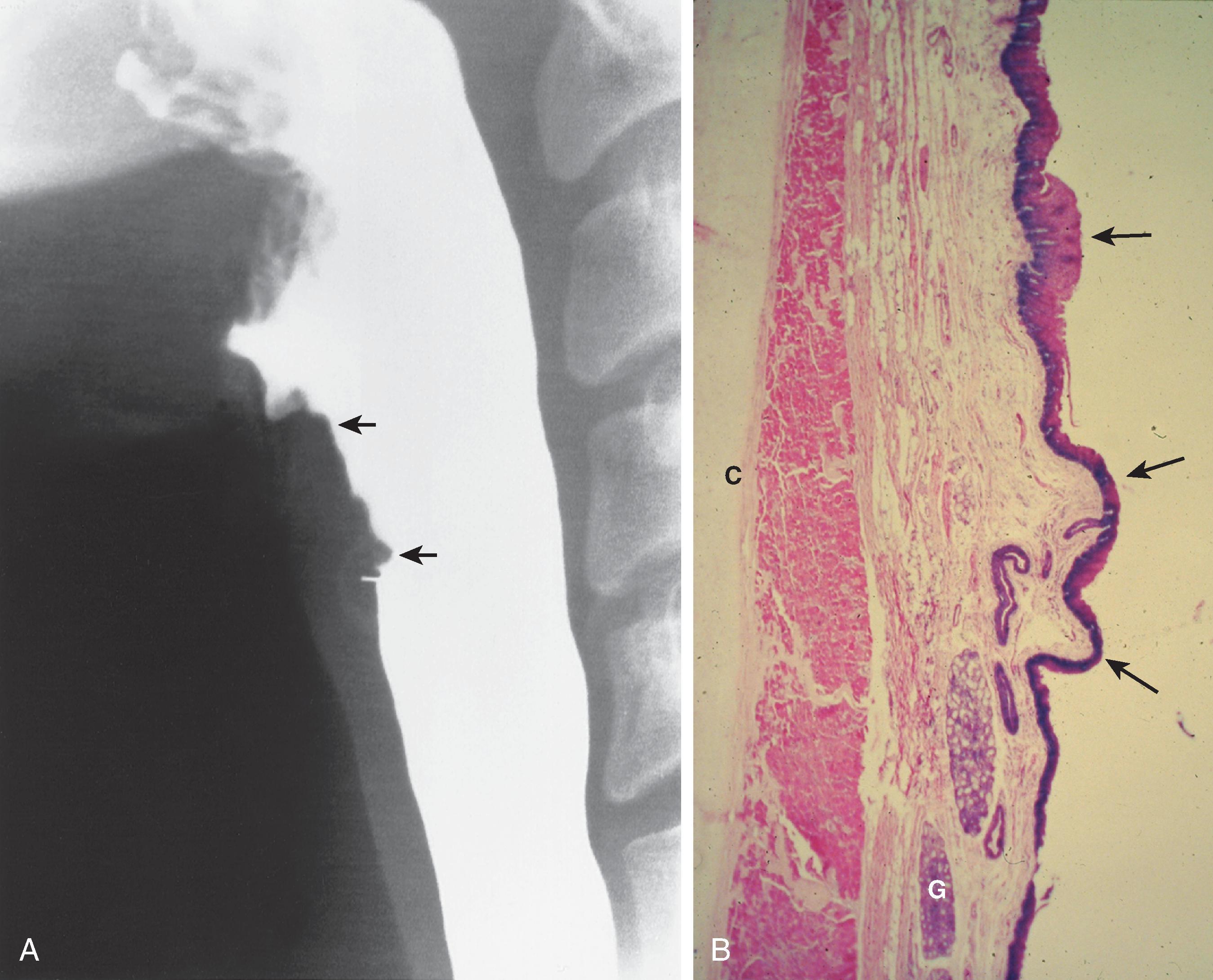 Fig. 4.6, The “postcricoid defect.” (A) On a lateral view of the pharynx during swallowing, redundant mucosa on the anterior wall of the pharyngoesophageal segment just posterior to the cricoid cartilage has an undulating, nodular contour ( arrows ). To rule out a subtle stricture, web, or infiltrating lesion, the radiologist must be certain that this nodularity changes in size and shape and flattens during swallowing. (B) Vertically oriented, low-power photomicrograph just posterior to the cricoid cartilage (C). The squamous epithelium has an undulating contour ( arrows ), accounting for the radiographic findings in (A). The tunica propria is thick, with abundant fat and several minor salivary glands ( G ) (H&E stain, ×10).