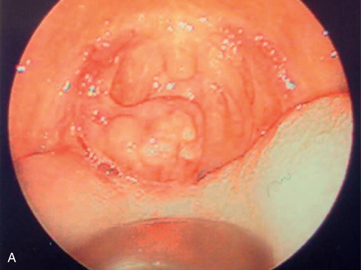 Figure 9.16, Squamous cell carcinomas of the tonsil. A , An exophytic lesion of the left tonsil. B , A submucosal lesion of the right tonsil.