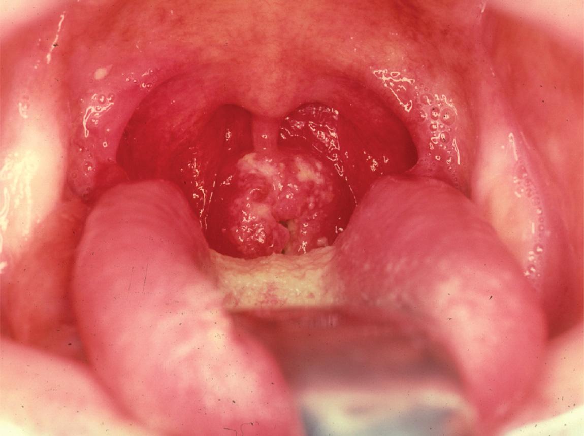 Figure 9.17, A carcinoma of the posterior pharyngeal wall.