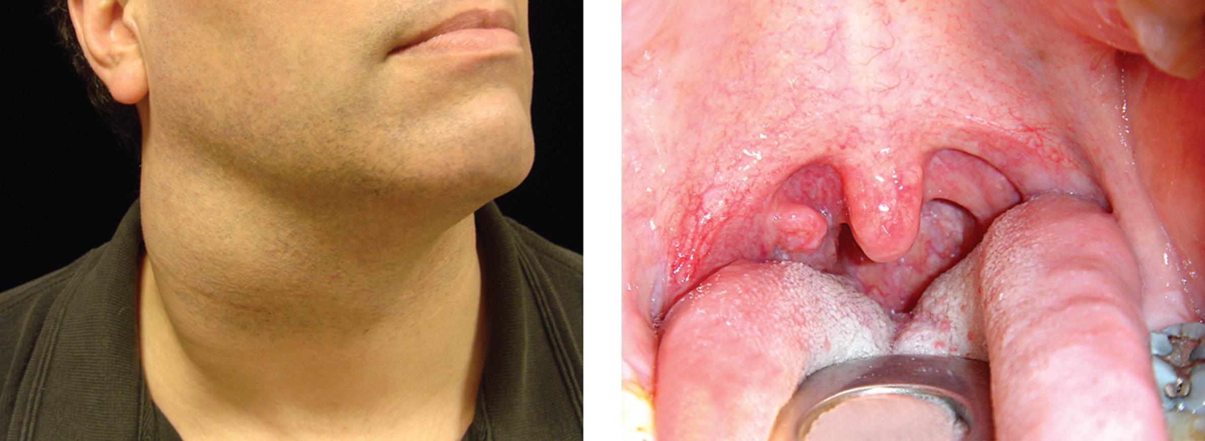 Figure 9.19, Bulky lymph node metastases to the neck from a small primary cancer of the right tonsil.