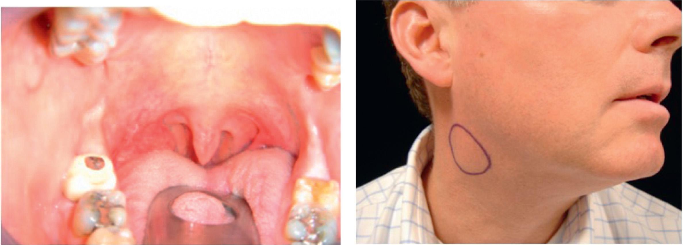 Figure 9.20, Carcinoma of the right tonsil (T1) with low volume (N1) nodal metastases.