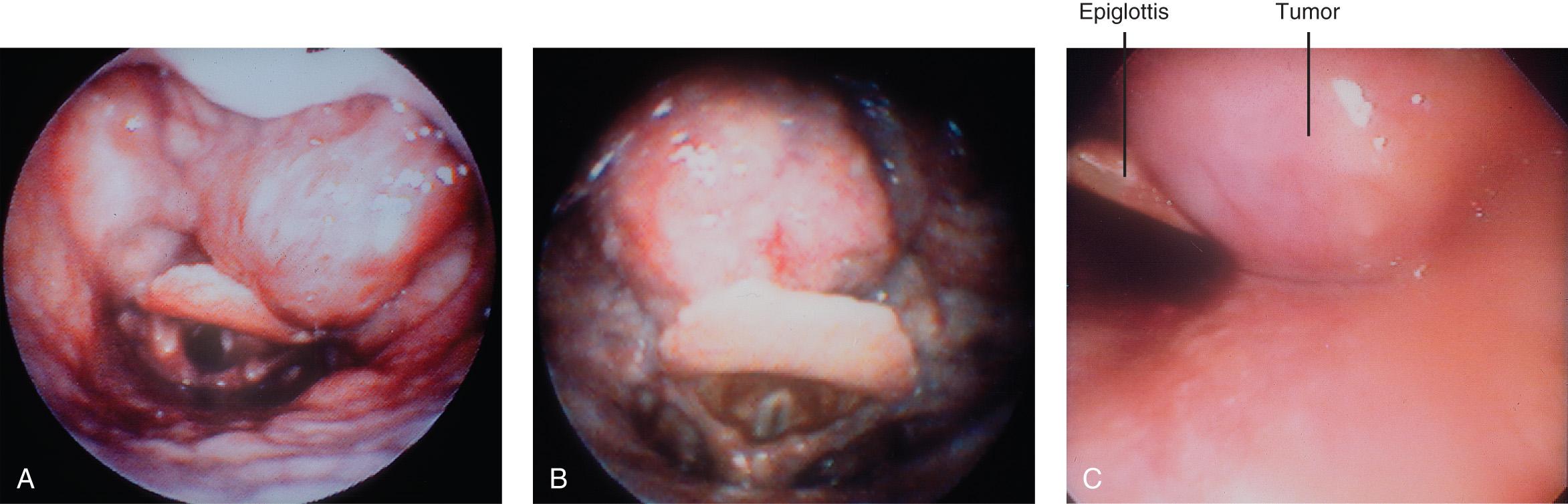 Figure 9.21, Endoscopic view of lesions of the base of the tongue. A , Hypertrophic lingual tonsil. B , Squamous cell carcinoma. C , Adenocarcinoma.