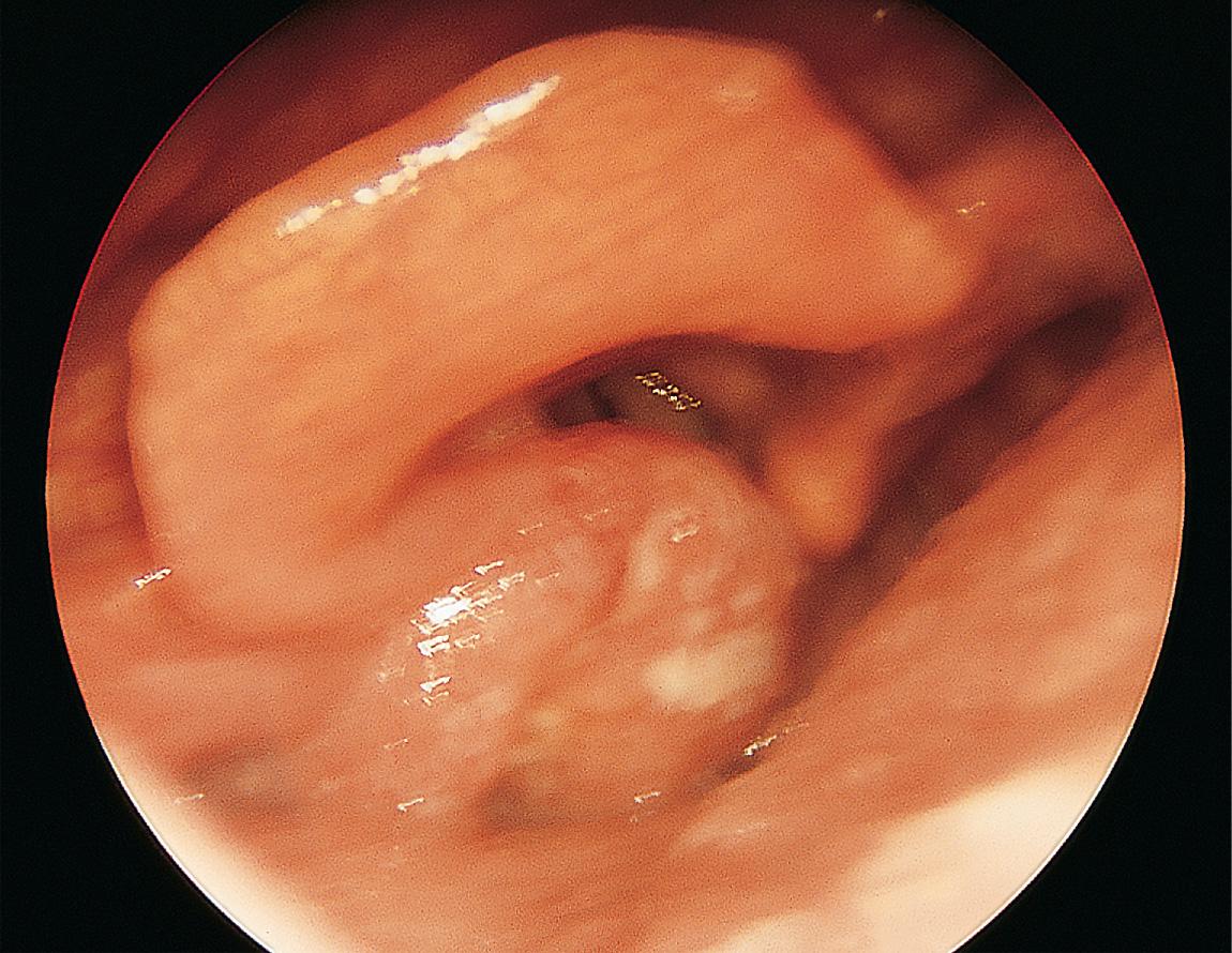 Figure 9.22, A carcinoma of the medial wall of the left pyriform sinus with extension to the arytenoid.