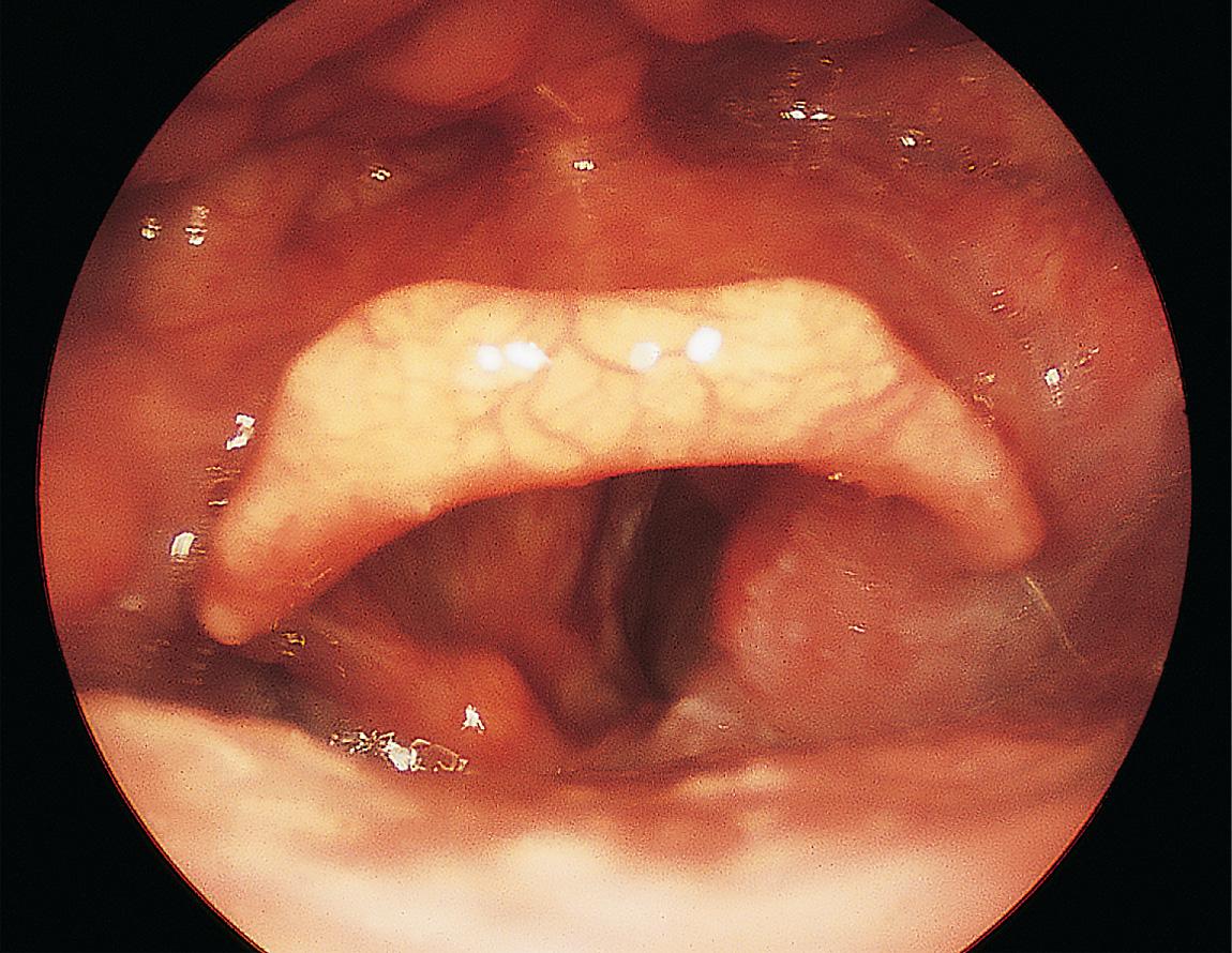 Figure 9.23, An advanced carcinoma of the right pyriform sinus with transglottic invasion.