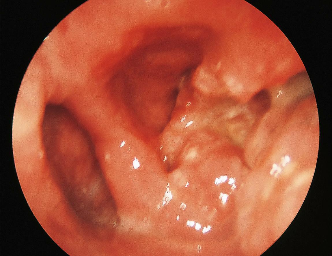 Figure 9.25, An advanced carcinoma of the right pyriform sinus with extension to the larynx.